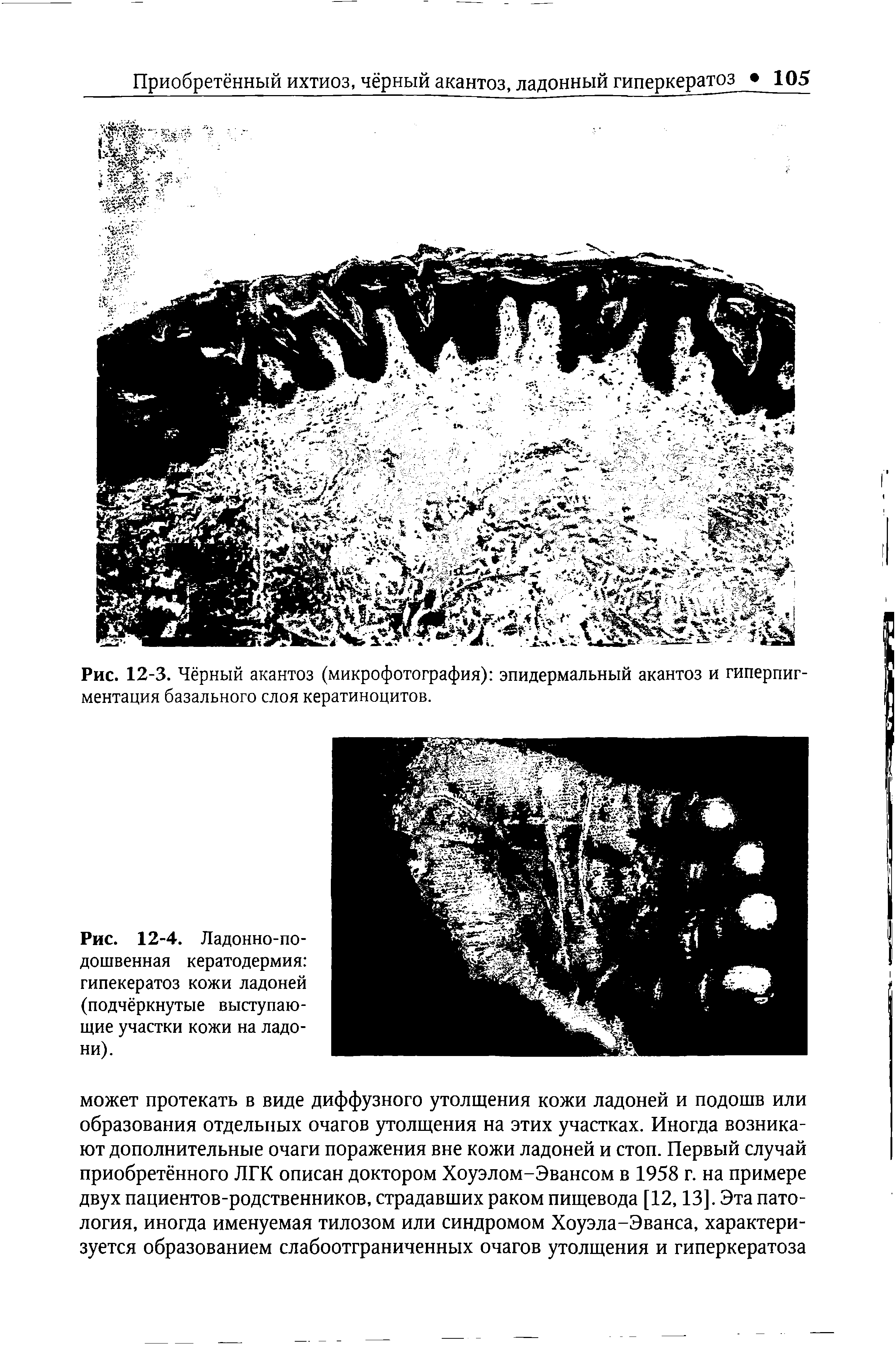 Рис. 12-3. Чёрный акантоз (микрофотография) эпидермальный акантоз и гиперпигментация базального слоя кератиноцитов.