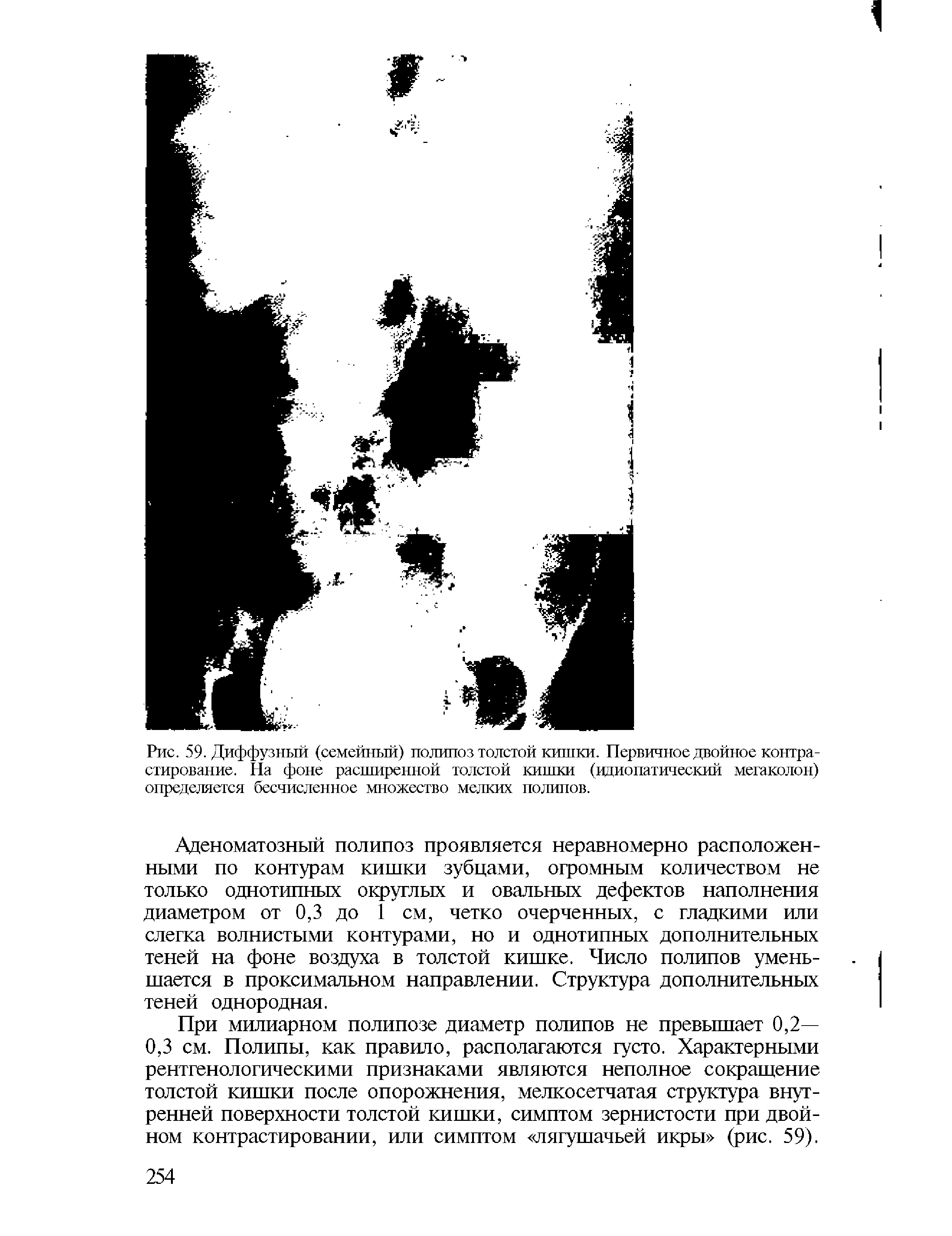 Рис. 59. Диффузный (семейный) полипоз толстой кишки. Первичное двойное контрастирование. На фоне расширенной толстой кишки (идиопатический мегаколон) определяется бесчисленное множество мелких полипов.