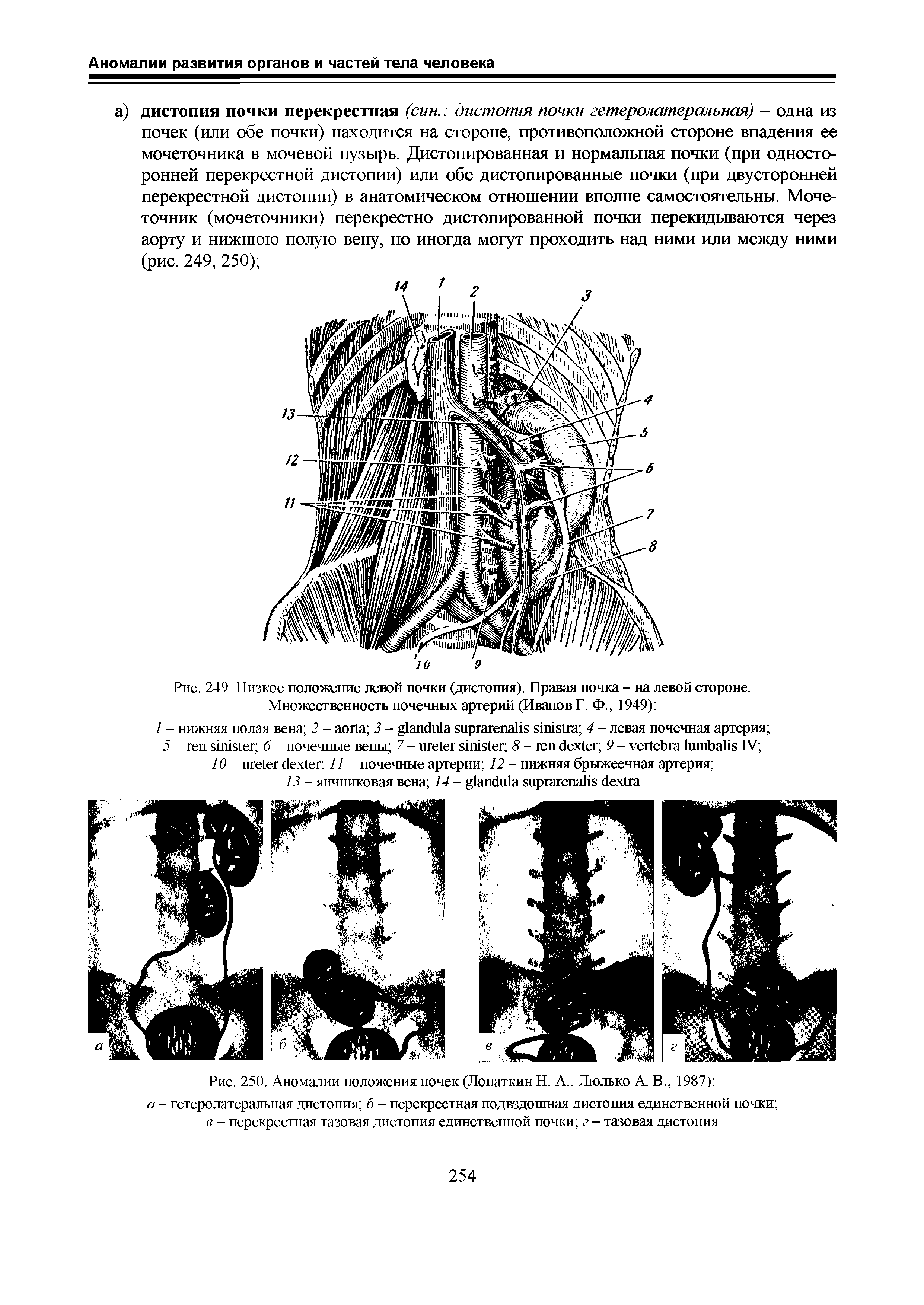 Рис. 249. Низкое положение левой почки (дистопия). Правая почка - на левой стороне. Множественность почечных артерий (Иванов Г. Ф., 1949) ...