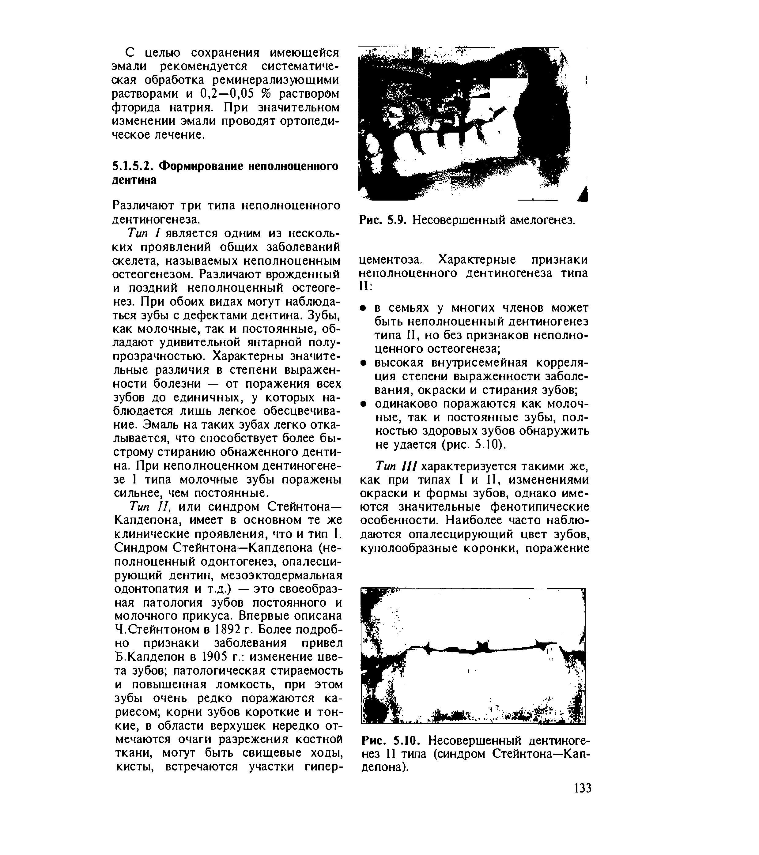 Рис. 5.10. Несовершенный дентиногенез 11 типа (синдром Стейнтона—Капдепона).