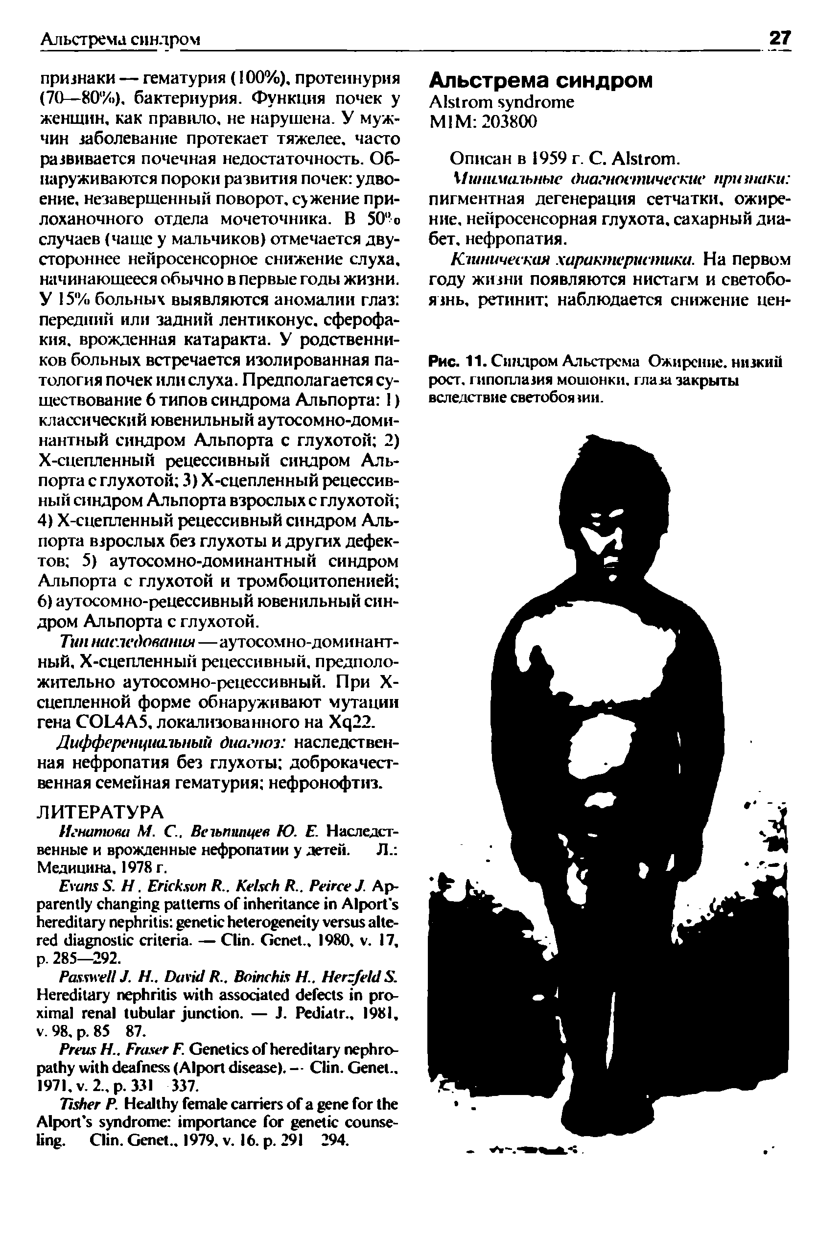 Рис. 11. Синдром Альстрема Ожирение, низкий рост, гипоплазия мошонки, глаза закрыты вследствие светобоя ши.