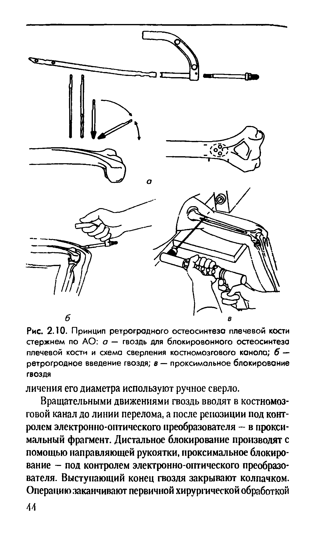 Рис. 2.10. Принцип ретроградного остеосинтеза плечевой кости стержнем по АО о — гвоздь для блокированного остеосинтеза плечевой кости и схема сверления костномозгового канола б — ретрогродное введение гвоздя в — проксимальное блокирование гвоздя...