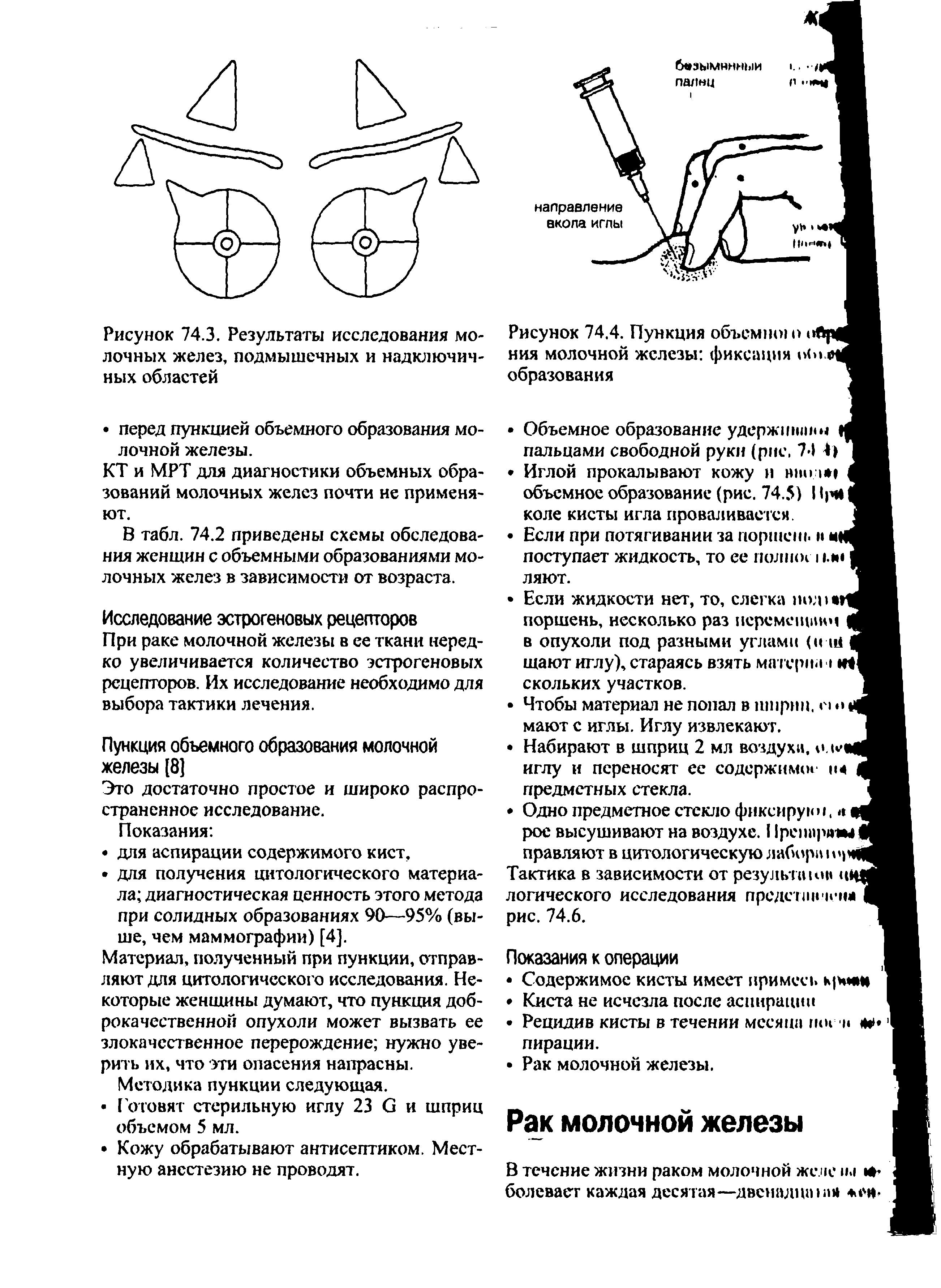 Рисунок 74.4. Пункция объемно о ой ния молочной железы фиксация о<>м образования...