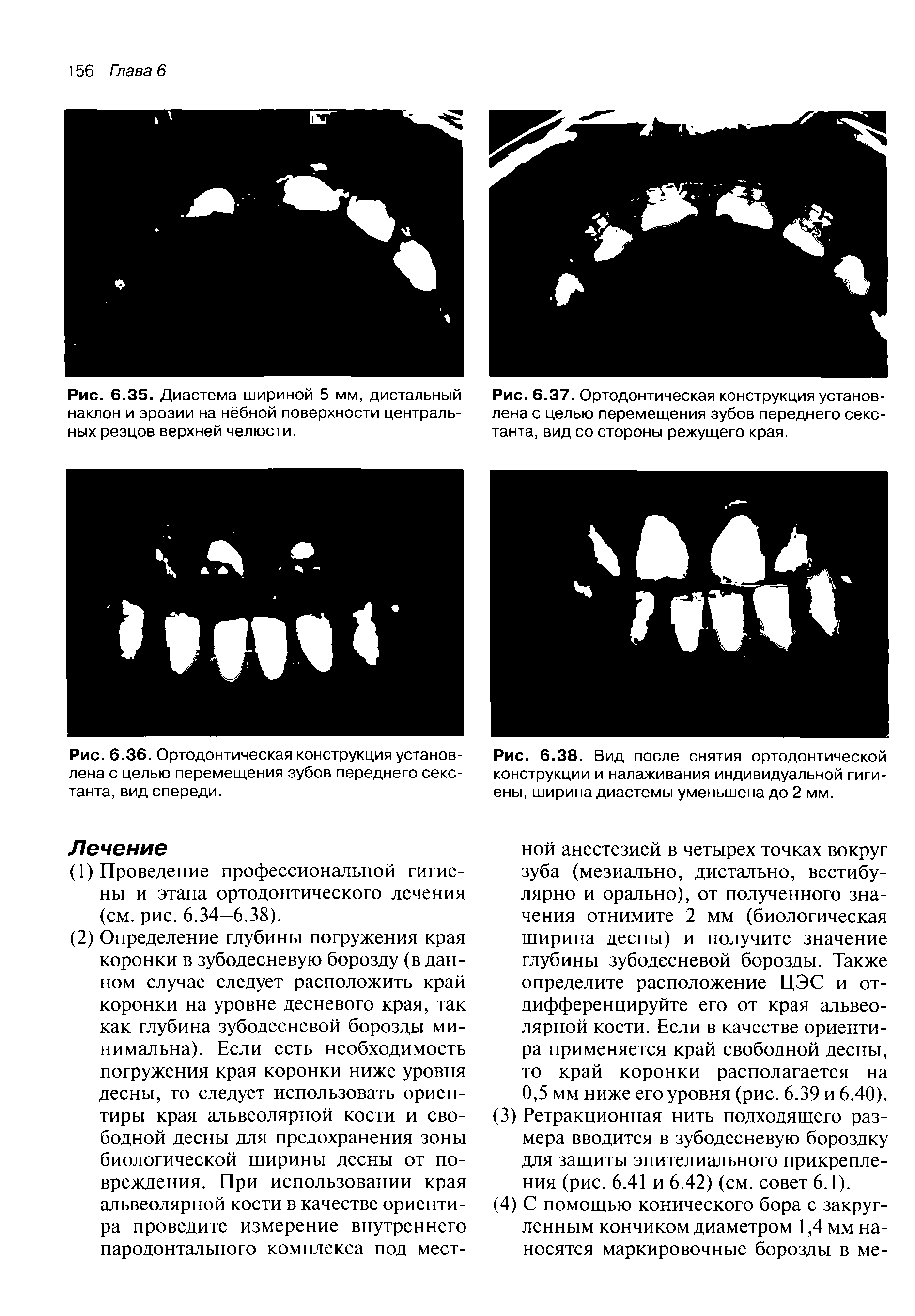 Рис. 6.37. Ортодонтическая конструкция установлена с целью перемещения зубов переднего секстанта, вид со стороны режущего края.