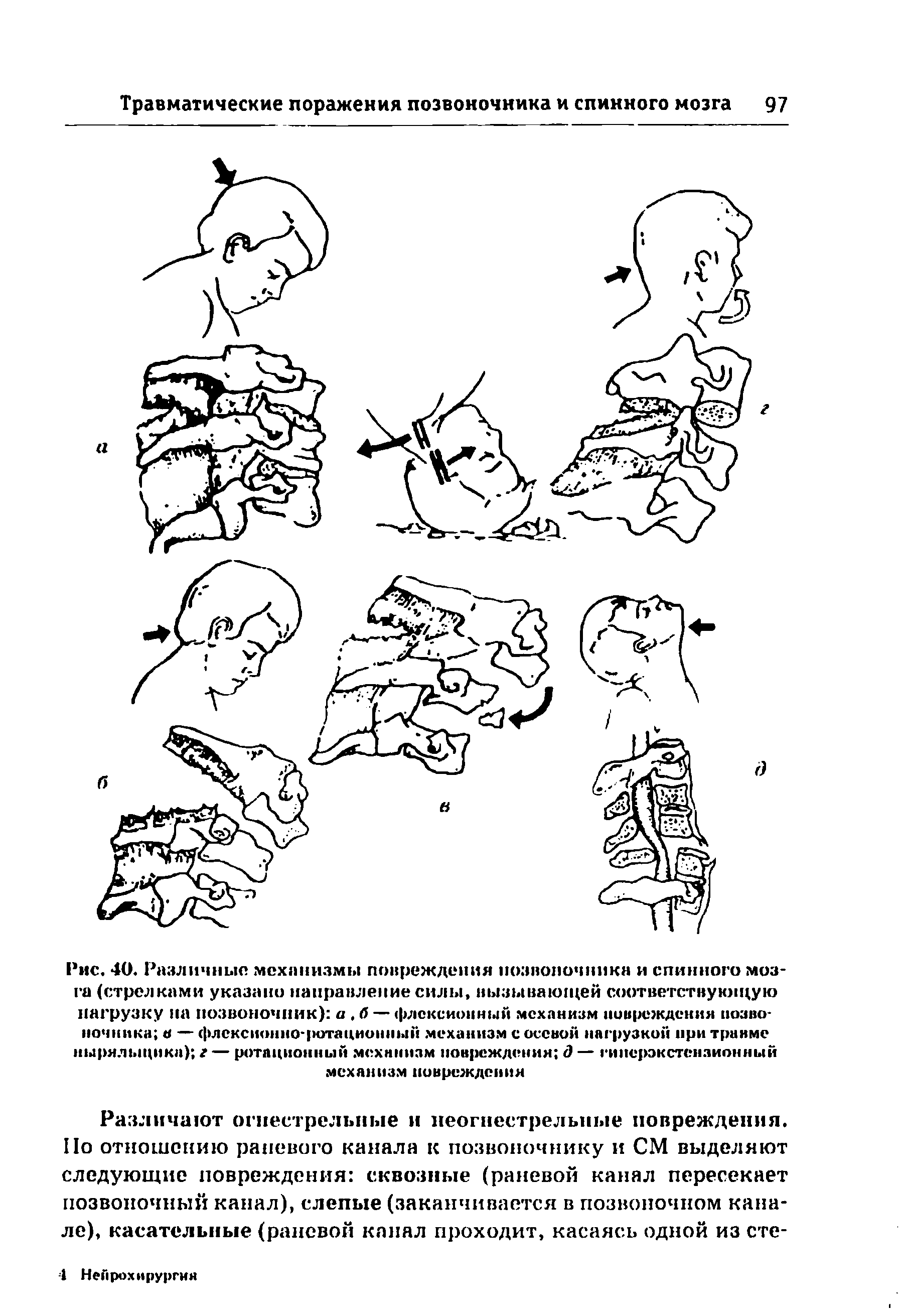 Рис. 40. Различные механизмы повреждения позвоночника и спинного мозга (стрелками указано направление силы, вызывающей соответствующую нагрузку па позвоночник) а. б — флексионный механизм повреждения позвоночника в — флексионно-ротационный механизм с осевой нагрузкой при травме ныряльщика) г — ротационный механизм повреждения д — гипсрэкстснзионный механизм повреждения...