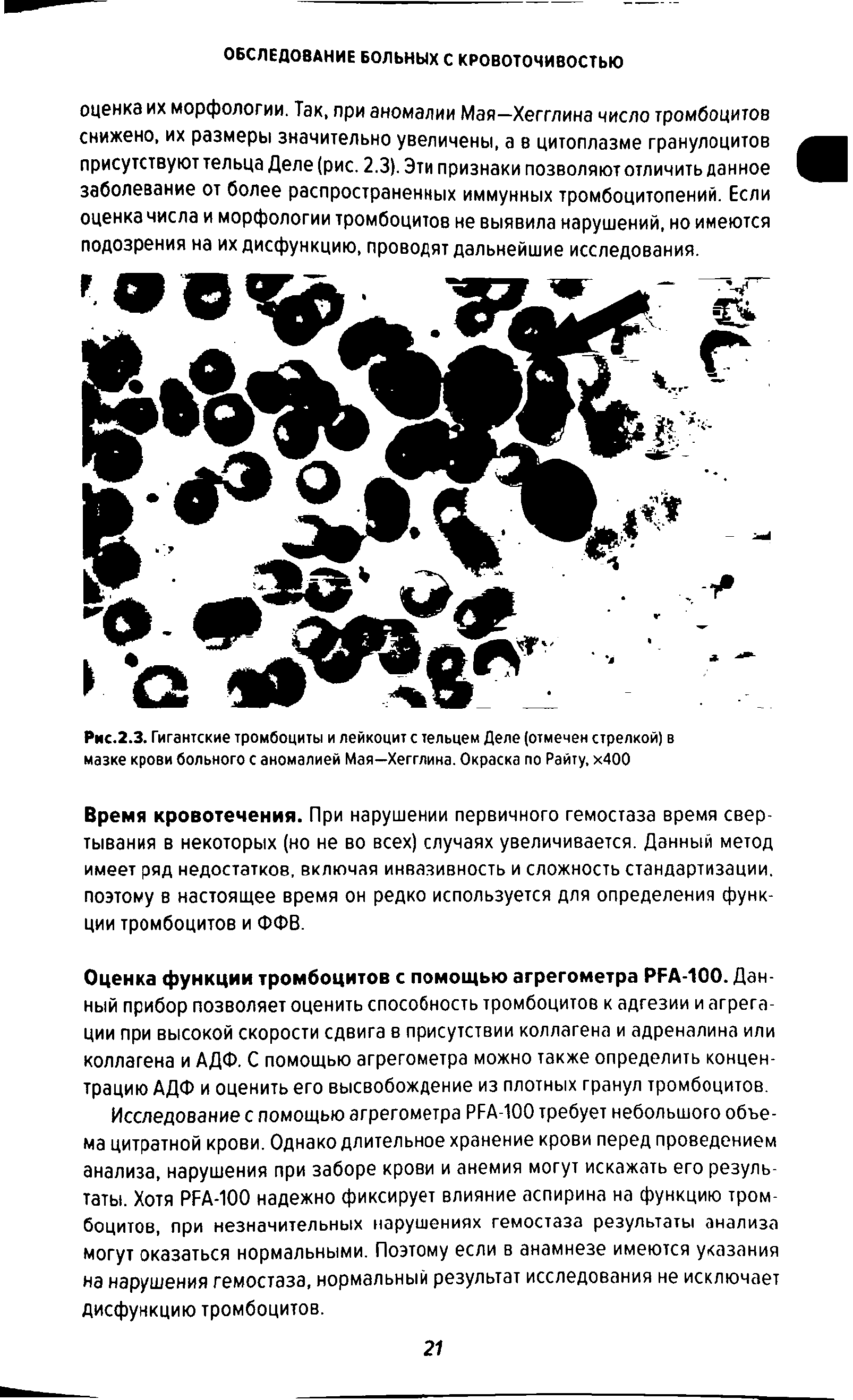 Рис.2.3. Гигантские тромбоциты и лейкоцит с тельцем Деле (отмечен стрелкой) в мазке крови больного с аномалией Мая-Хегглина. Окраска по Райту, х400...