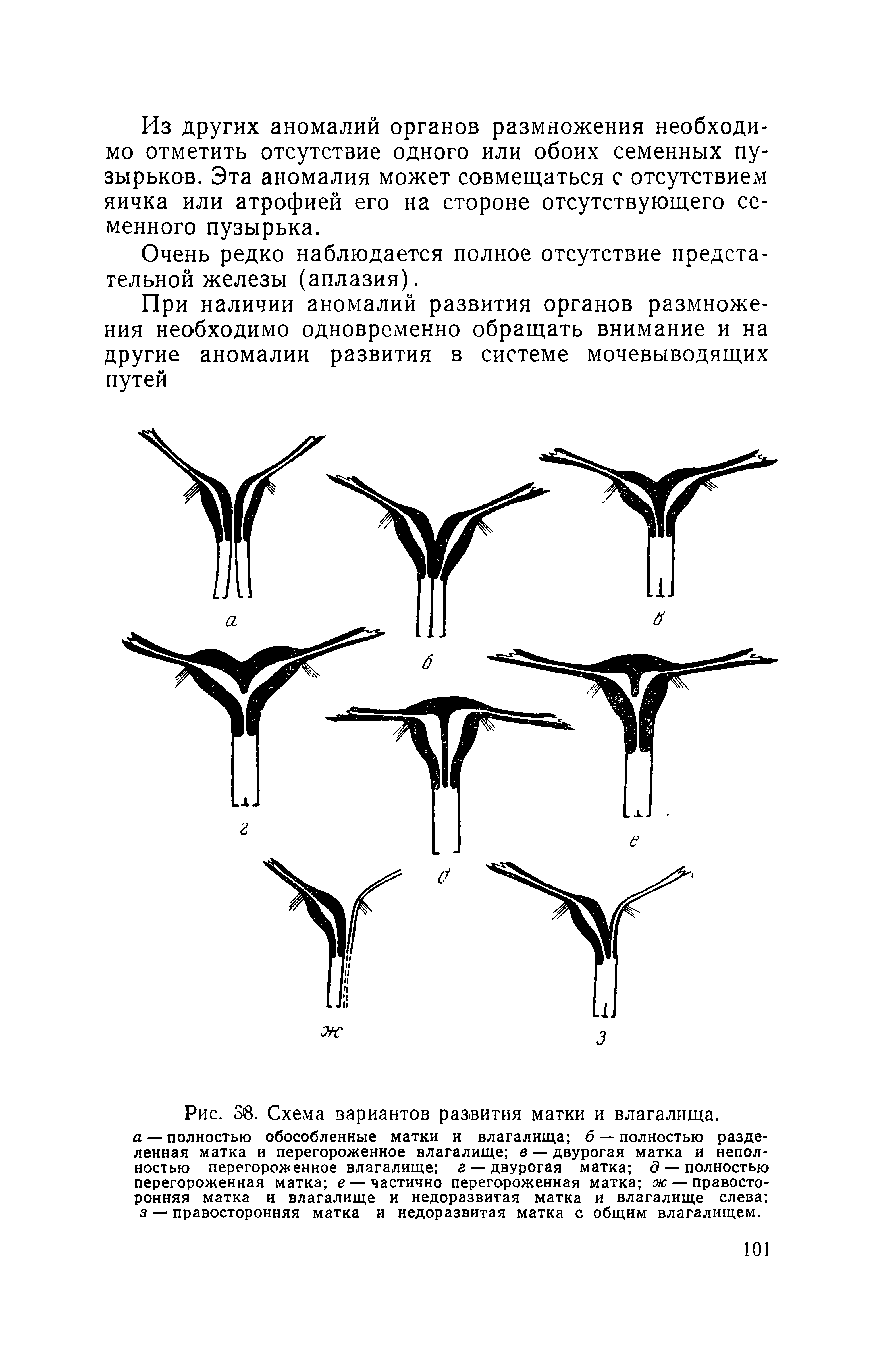Рис. Зв. Схема вариантов развития матки и влагалища. а — полностью обособленные матки и влагалища б — полностью разделенная матка и перегороженное влагалище в — двурогая матка и неполностью перегороженное влагалище г — двурогая матка д — полностью перегороженная матка е — частично перегороженная матка ж — правосторонняя матка и влагалище и недоразвитая матка и влагалище слева ...