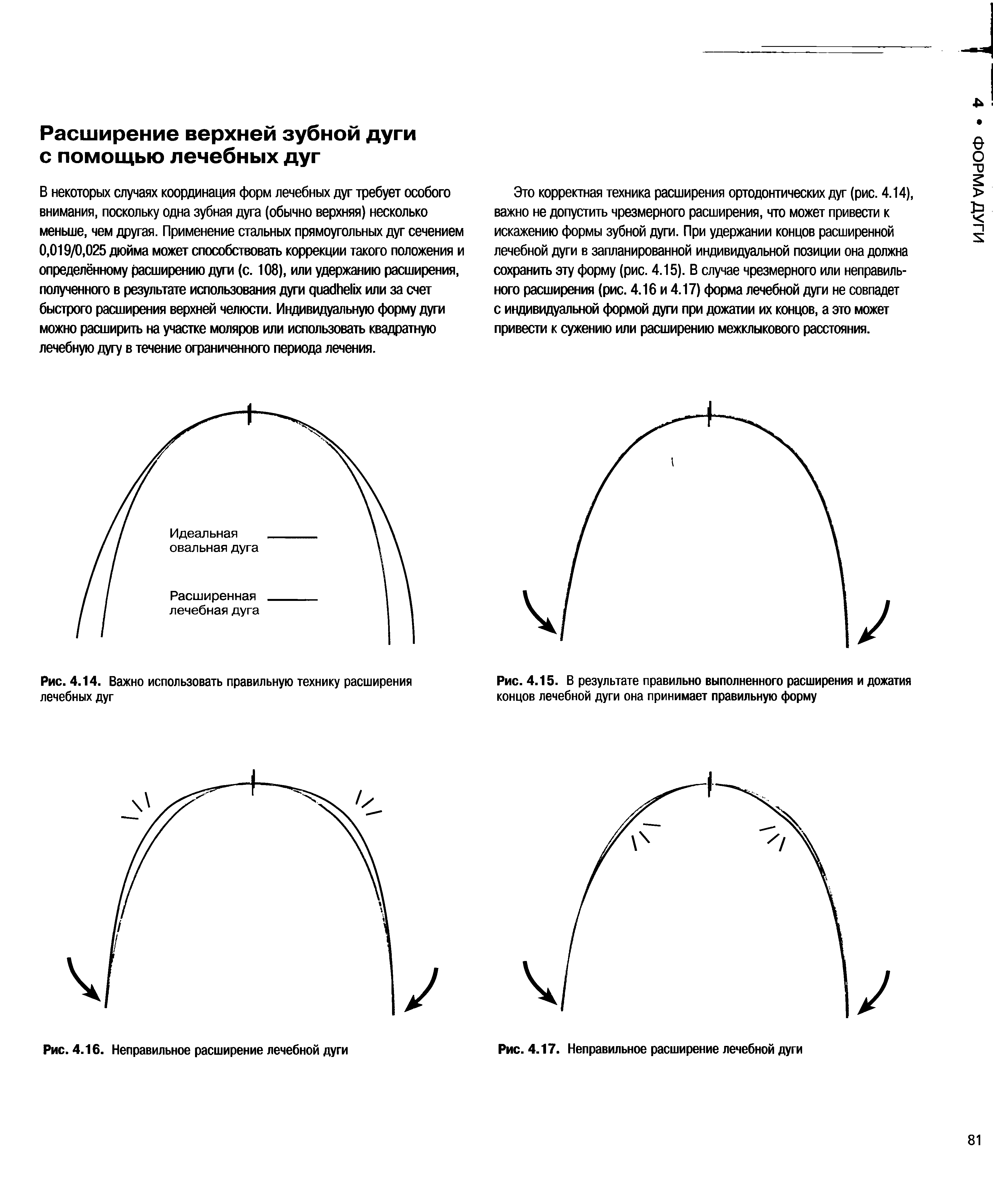 Рис. 4.14. Важно использовать правильную технику расширения лечебных дуг...