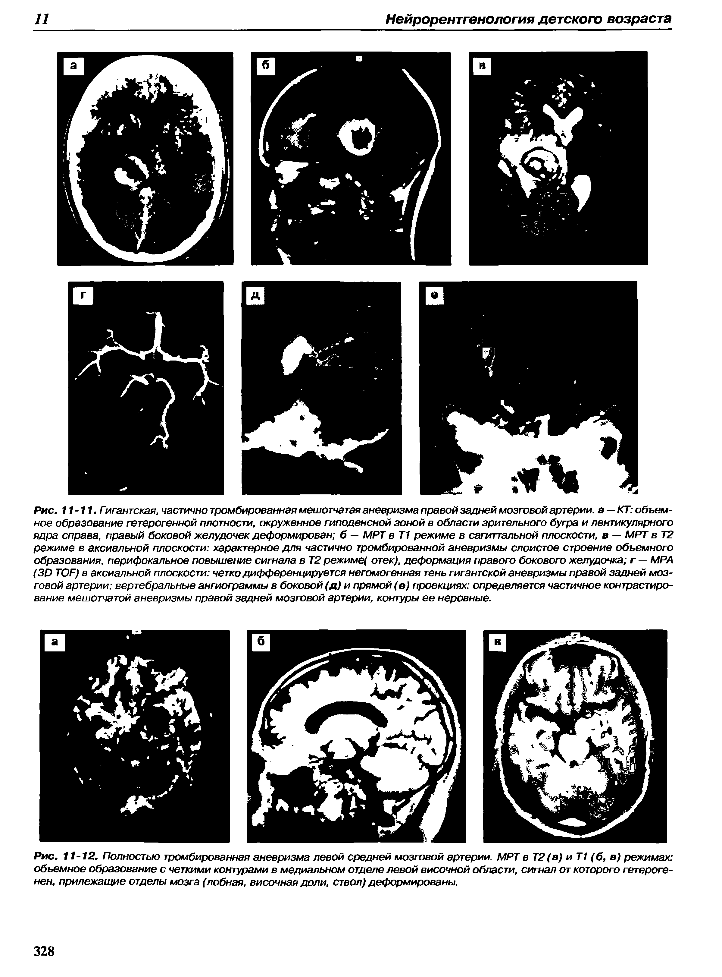 Рис. 11-12. Полностью тромбированная аневризма левой средней мозговой артерии. МРТ в Т2(а) и Т1 (б, в) режимах объемное образование с четкими контурами в медиальном отделе левой височной области, сигнал от которого гетероге-нен, прилежащие отделы мозга (лобная, височная доли, ствол) деформированы.