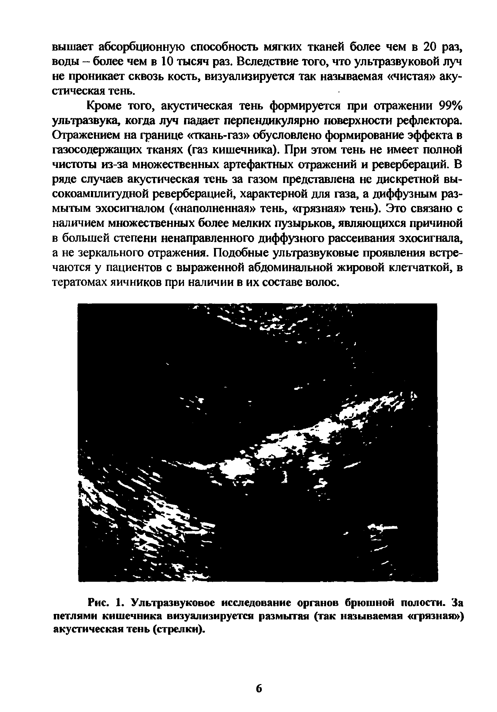 Рис. 1. Ультразвуковое исследование органов брюшной полости. За петлями кишечника визуализируется размытая (так называемая грязная ) акустическая тень (стрелки).