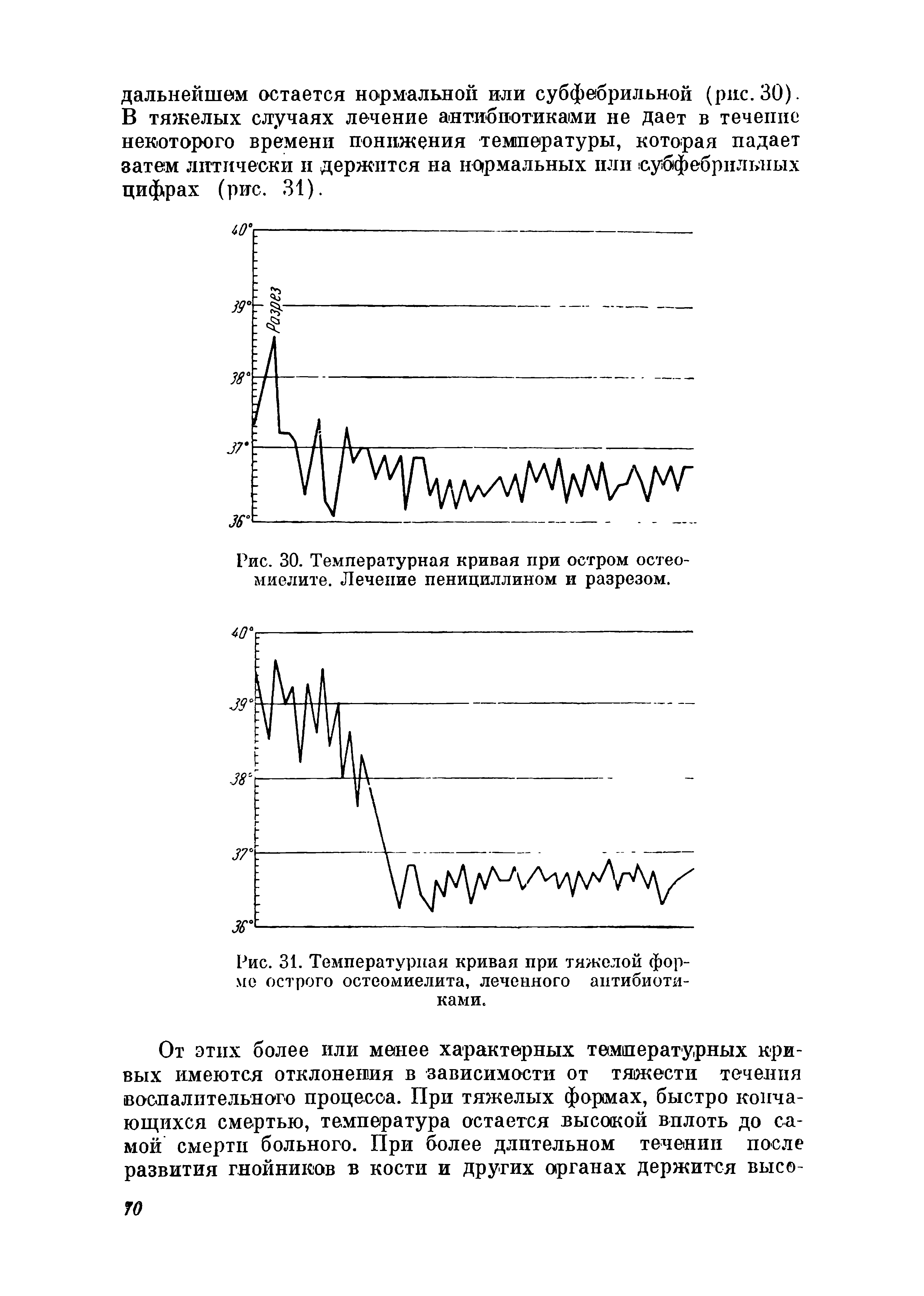 Рис. 30. Температурная кривая при остром остеомиелите. Лечение пенициллином и разрезом.
