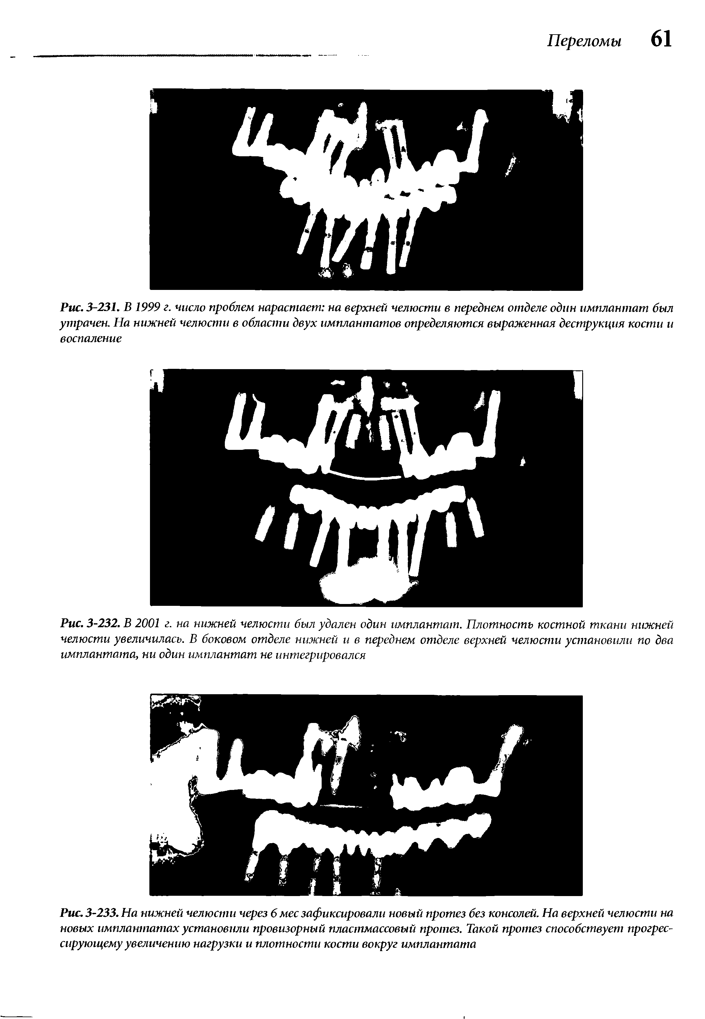 Рис. 3-232. В 2001 г. на нижней челюсти был удален один имплантат. Плотность костной ткани нижней челюсти увеличилась. В боковом отделе нижней и в переднем отделе верхней челюсти установили по два имплантата, ни один имплантат не интегрировался...