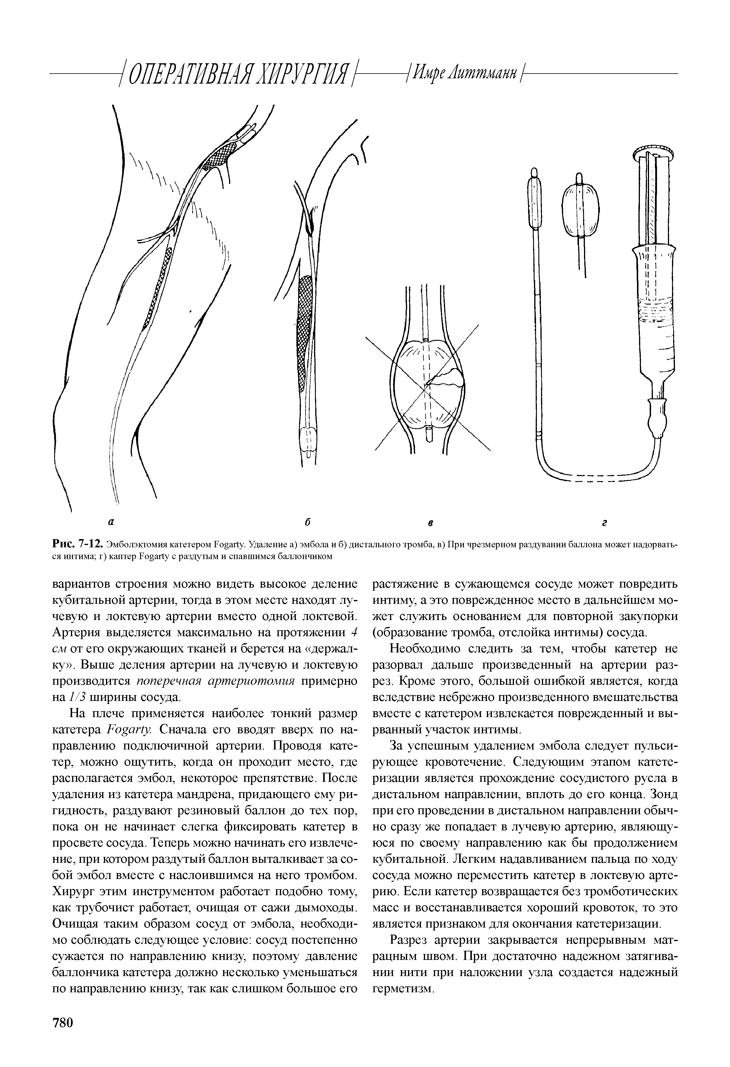 Рис. 7-12. Эмболэктомия катетером F . Удаление а) эмбола и б) дистального тромба, в) При чрезмерном раздувании баллона может надорваться интима г) каптер F с раздутым и спавшимся баллончиком...