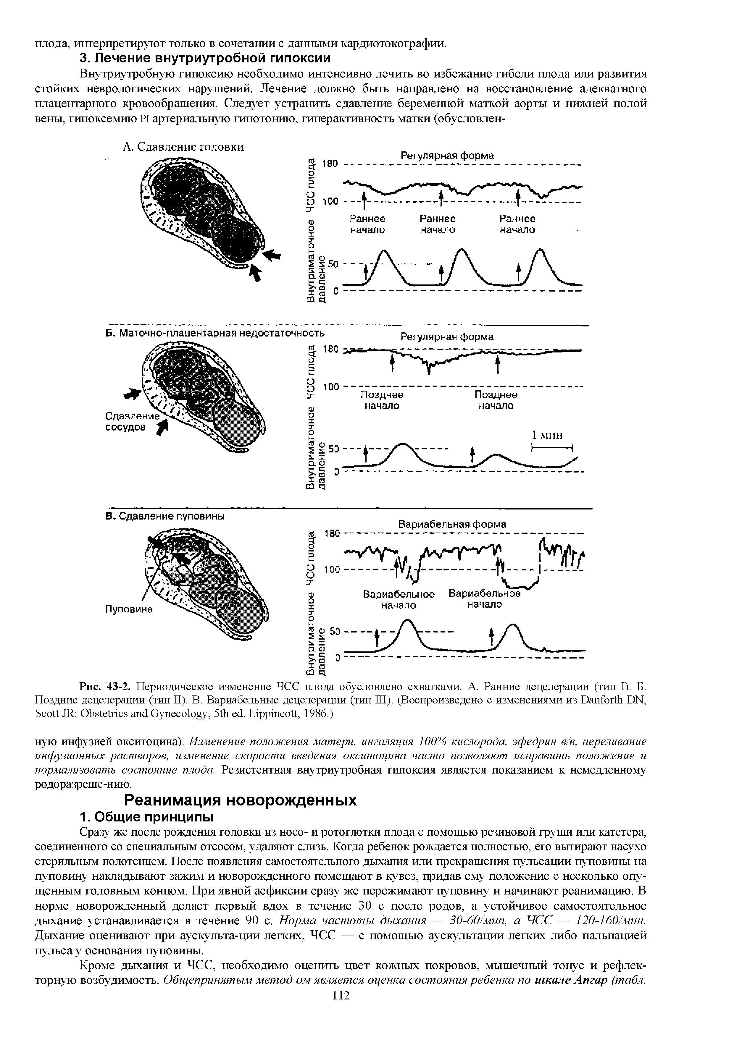 Рис. 43-2. Периодическое изменение ЧСС плода обусловлено схватками. А. Ранние децелерации (тип I). Б. Поздние децелерации (тип II). В. Вариабельные децелерации (тип III). (Воспроизведено с изменениями из D DN, S JR O G , 5 . L , 1986.)...