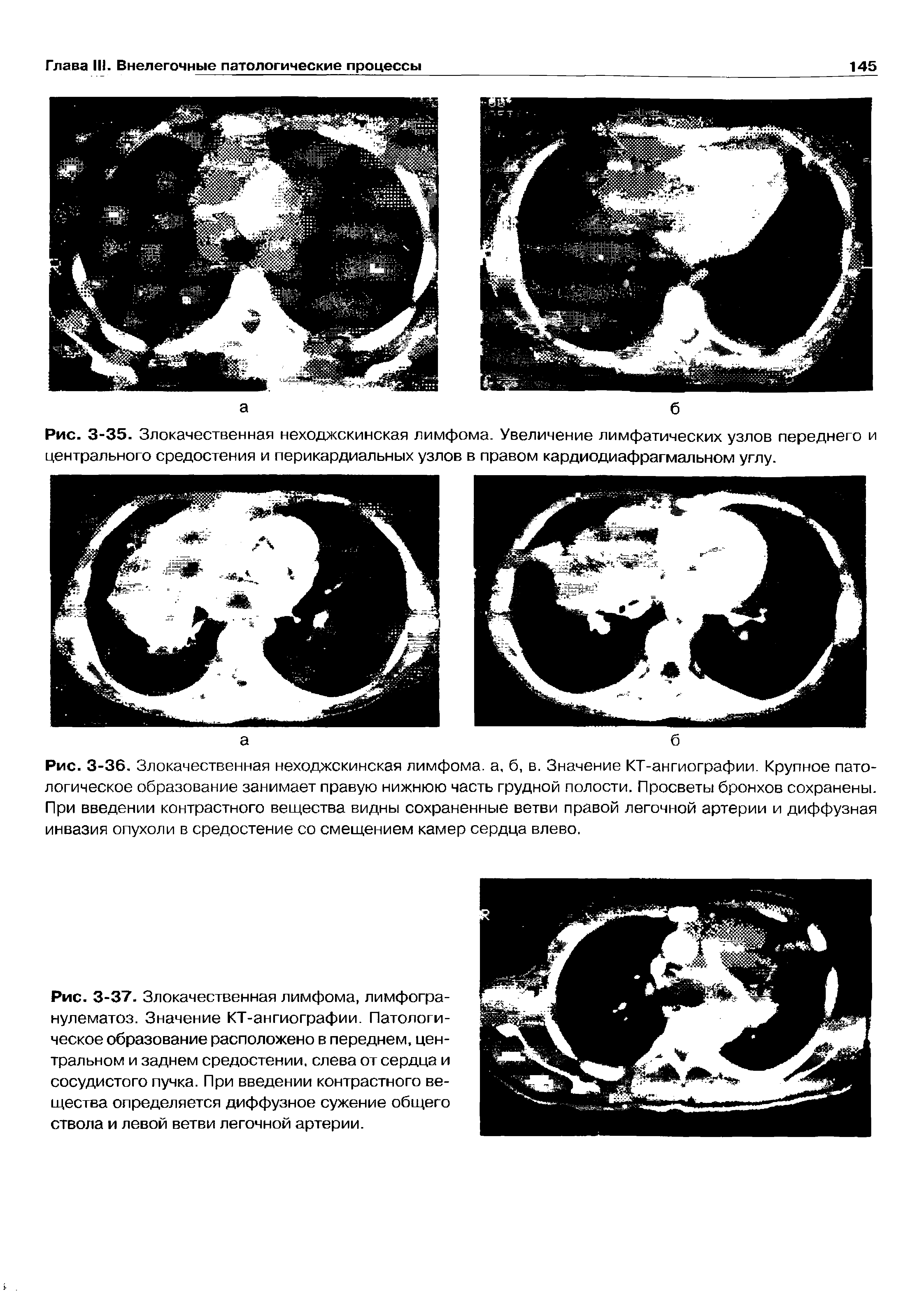 Рис. 3-37. Злокачественная лимфома, лимфогранулематоз. Значение КТ-ангиографии. Патологическое образование расположено в переднем, центральном и заднем средостении, слева от сердца и сосудистого пучка. При введении контрастного вещества определяется диффузное сужение общего ствола и левой ветви легочной артерии.