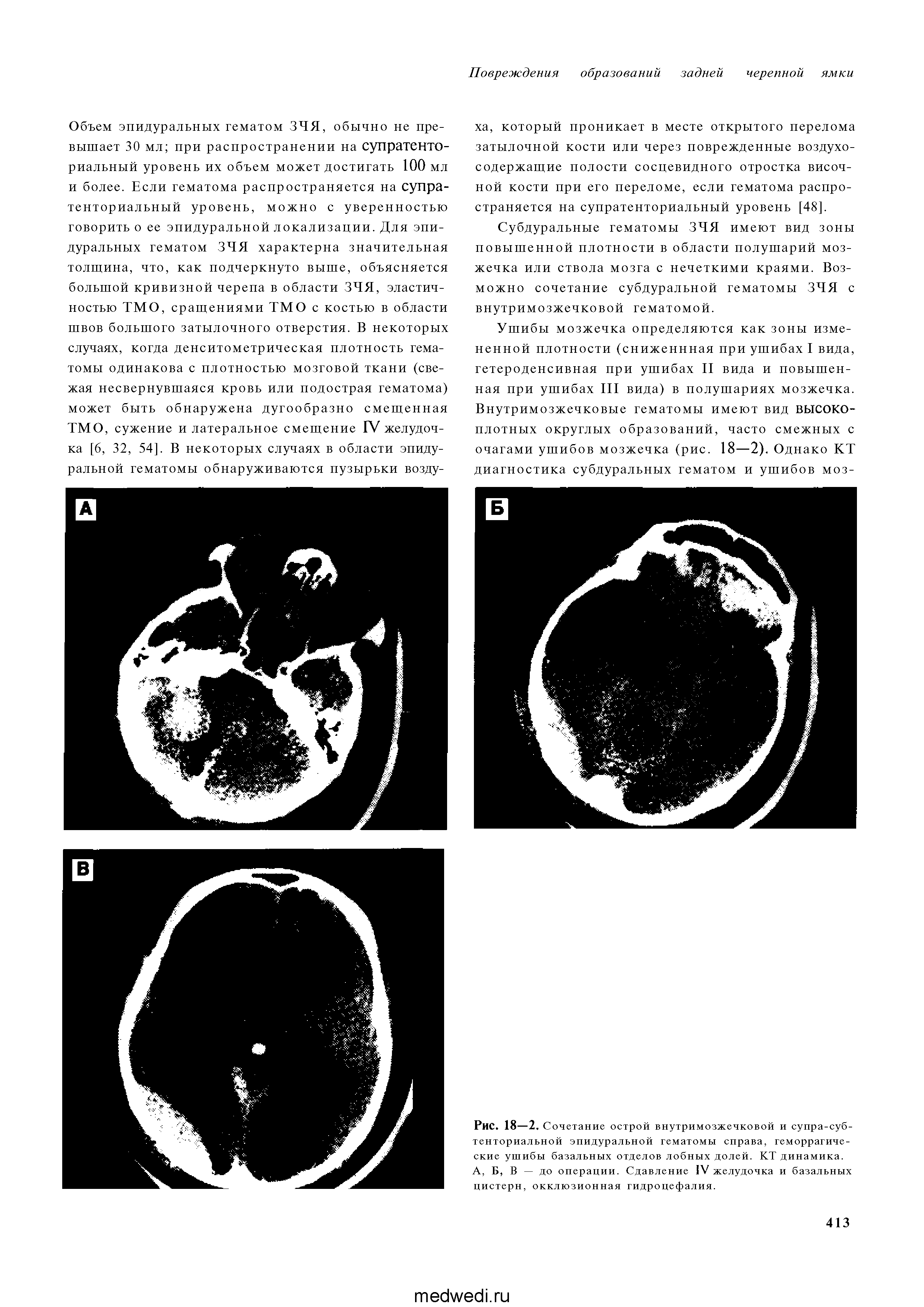 Рис. 18-2. Сочетание острой внутримозжечковой и супра-субтенториальной эпидуральной гематомы справа, геморрагические ушибы базальных отделов лобных долей. КТ динамика. А, Б, В — до операции. Сдавление IV желудочка и базальных цистерн, окклюзионная гидроцефалия.