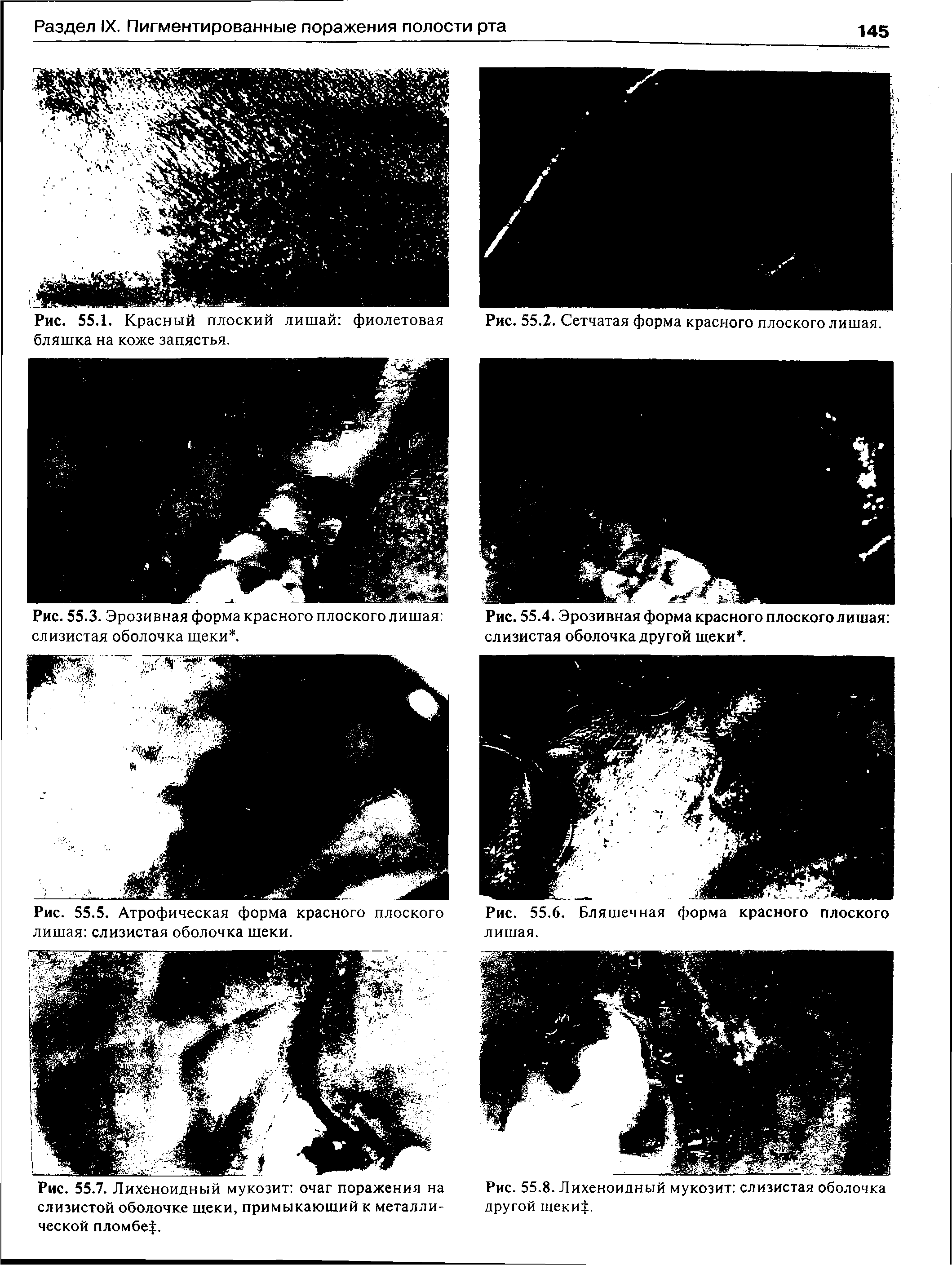 Рис. 55.3. Эрозивная форма красного плоского лишая слизистая оболочка щеки. ...