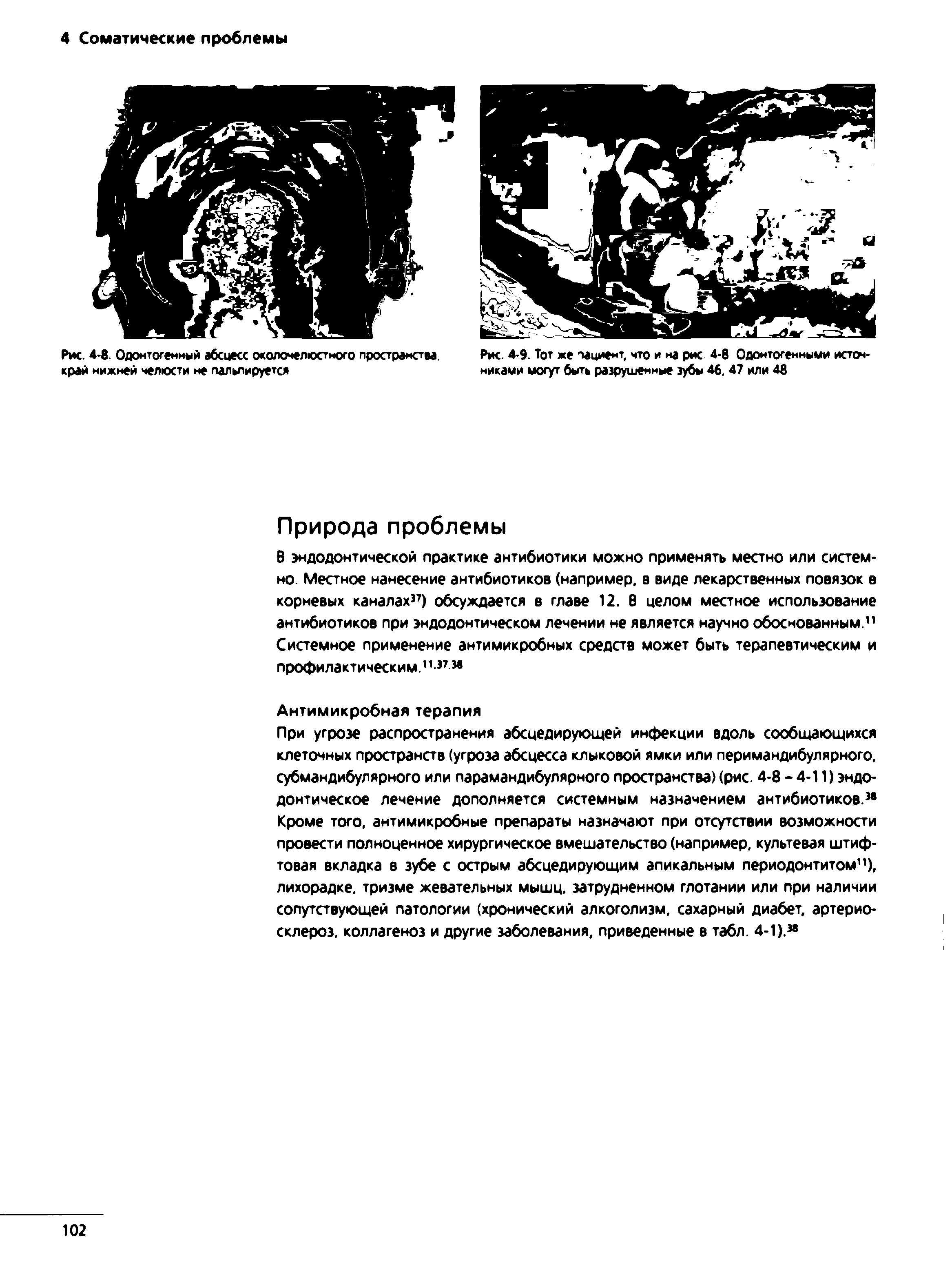 Рис. 4-8. Одонтогенный абсцесс околочелюстного пространства, край нижней челюсти не пальпируется...