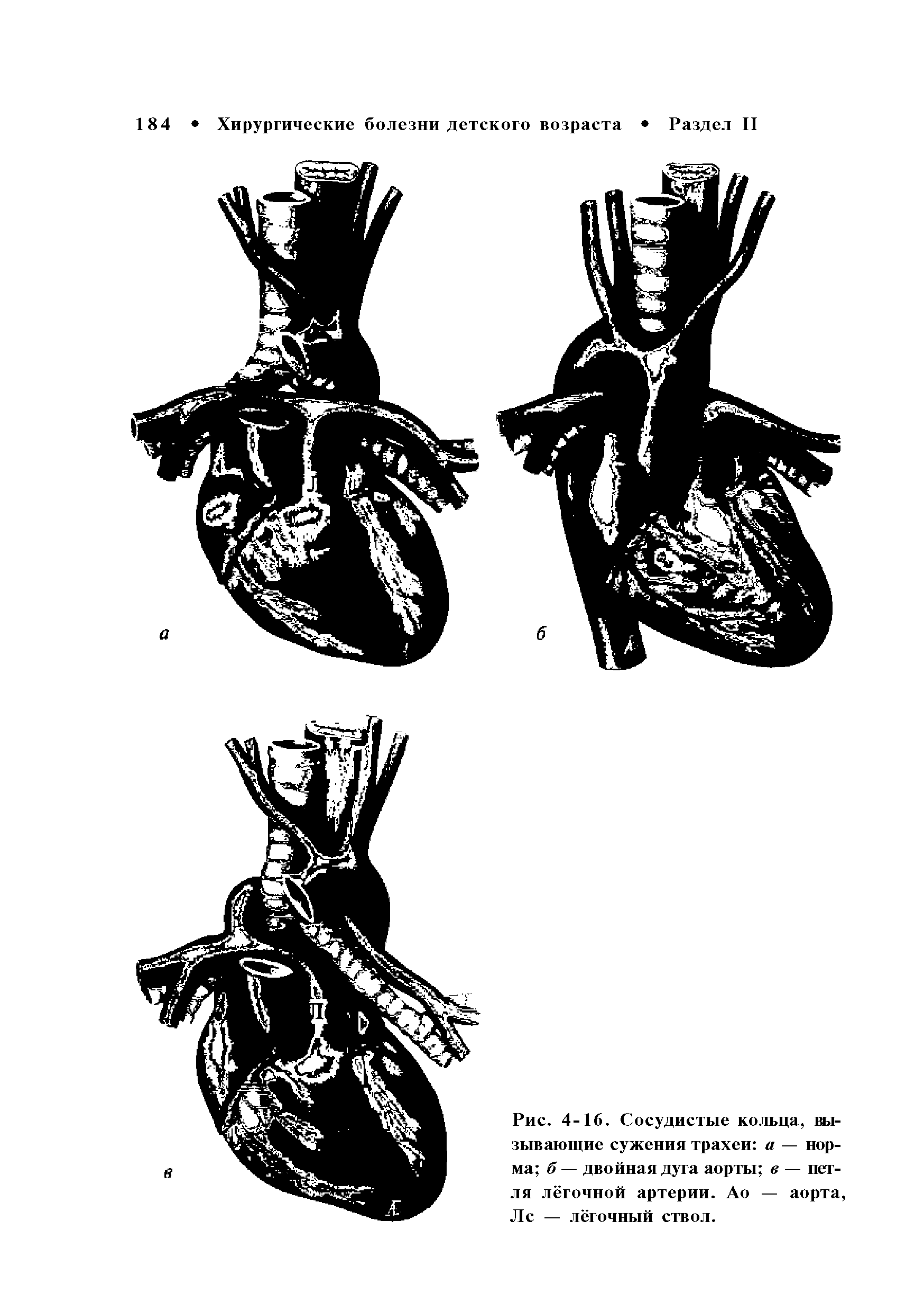 Рис. 4-16. Сосудистые кольца, вызывающие сужения трахеи а — норма б — двойная дуга аорты в — петля лёгочной артерии. Ао — аорта Лс — лёгочный ствол.