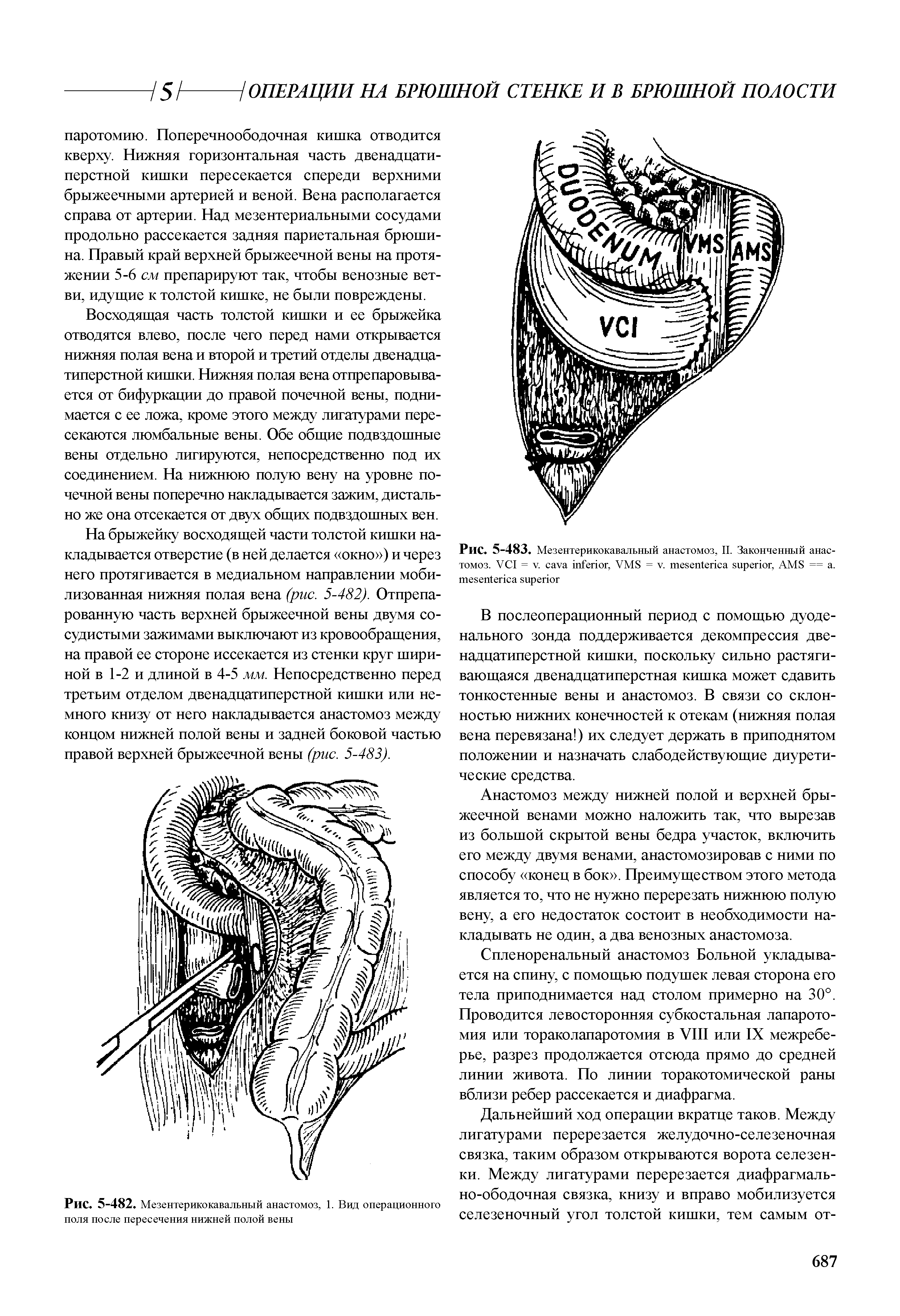 Рис. 5-483. Мезентерикокавальный анастомоз, II. Законченный анастомоз. VCI = V. , VMS = . , AMS == . ...