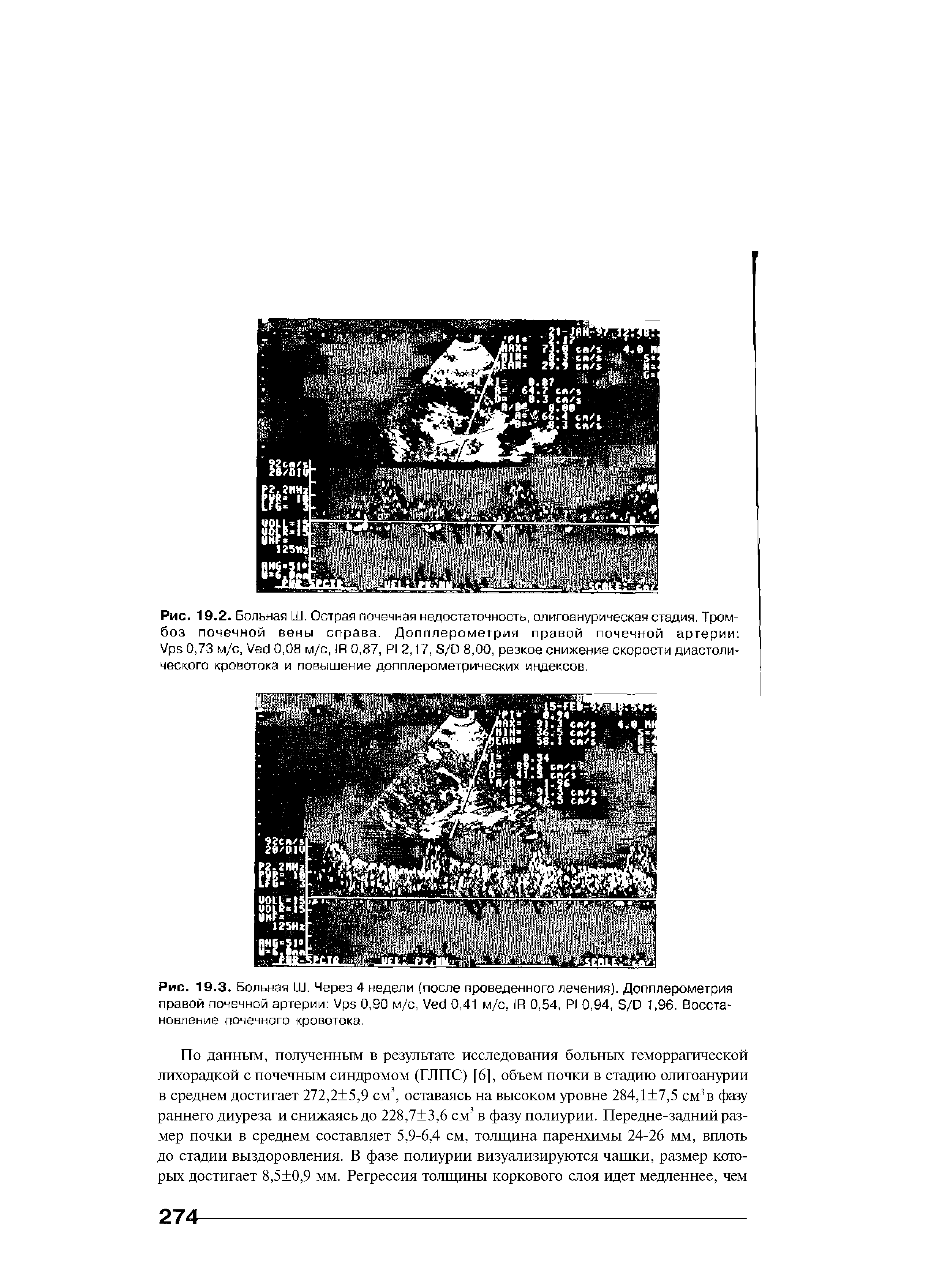Рис. 19.2. Больная Ш. Острая почечная недостаточность, олигоанурическая стадия, Тромбоз почечной вены справа. Допплерометрия правой почечной артерии V 0,73 м/с, V 0,08 м/с, R 0,87, PI 2,17, S/D 8,00, резкое снижение скорости диастолического кровотока и повышение допплерометрических индексов.