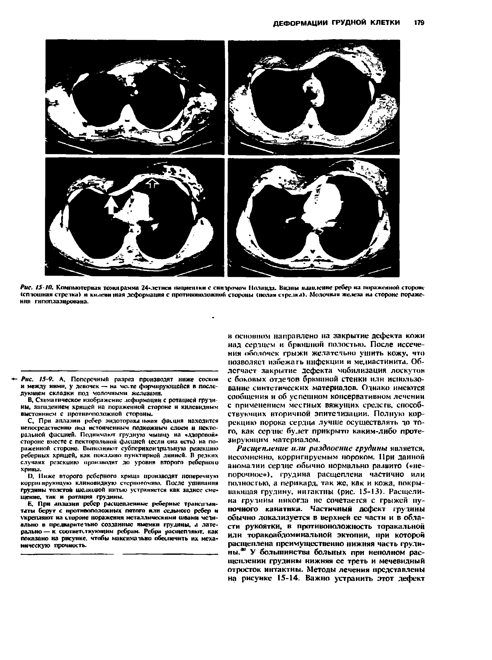 Рис. 15-10. Компьютерная томшрамма 24< 1ки(иен1ки с синдромом Поланда. Видны давление ребер на пораженной сторона-Се тошная стречка) и юыевншая деформация с протишнюложной стороны (полая с ре.жа). Молочная же.кгза на стороне поражения гипоплазнрована.