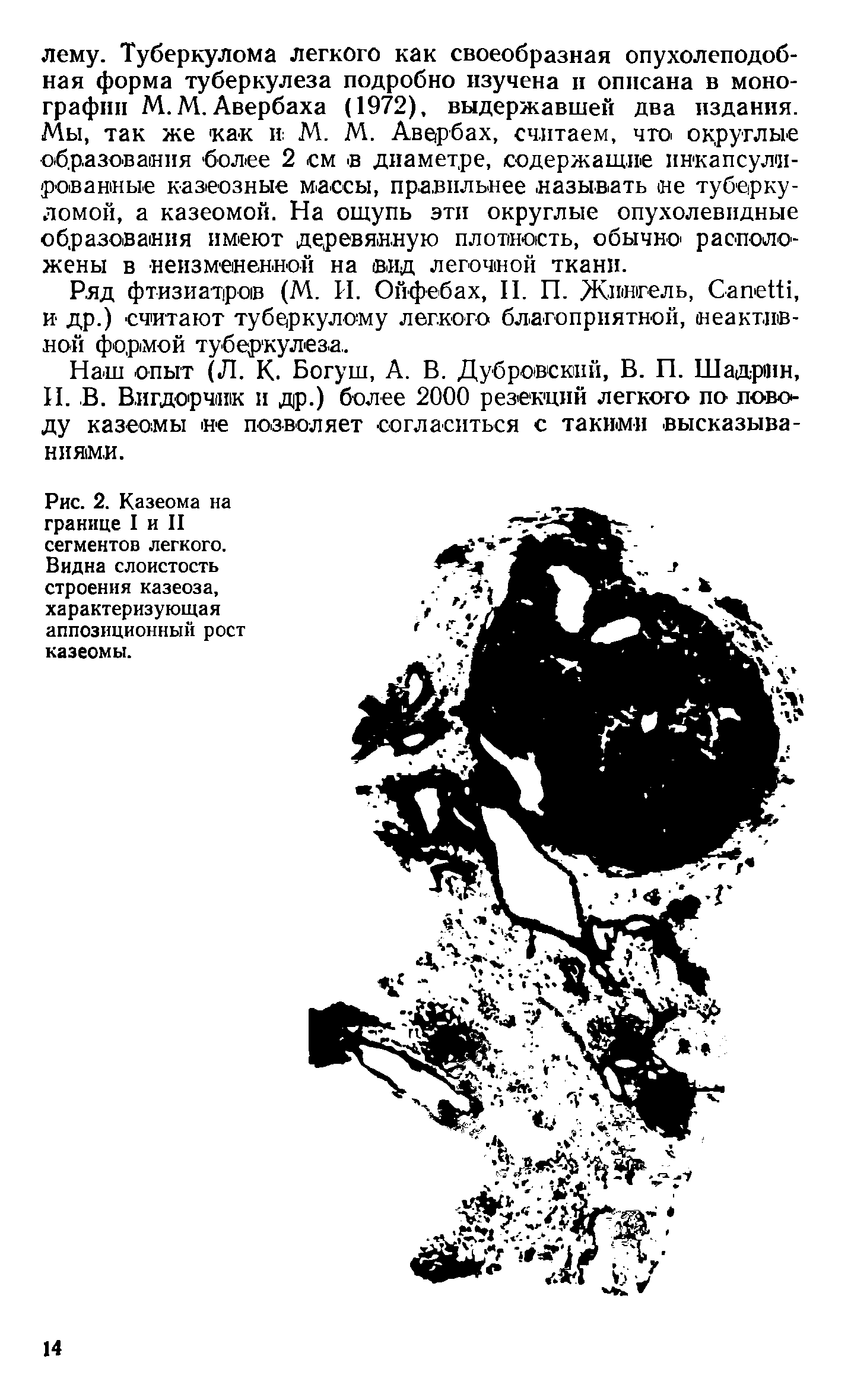 Рис. 2. Казеома на границе I и II сегментов легкого. Видна слоистость строения казеоза, характеризующая аппозиционный рост казеомы.