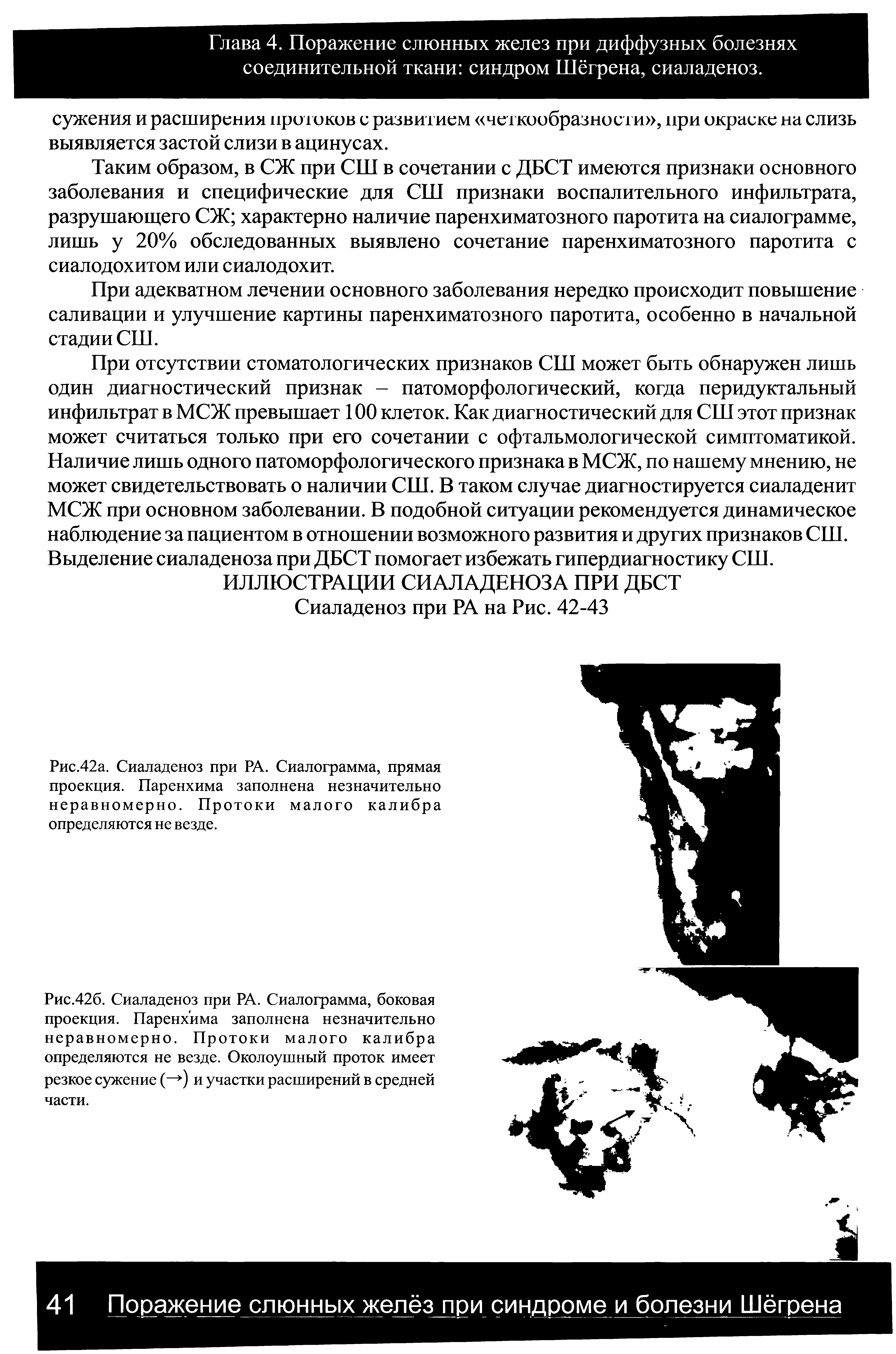 Рис.42б. Сиаладеноз при РА. Сиалограмма, боковая проекция. Паренхима заполнена незначительно неравномерно. Протоки малого калибра определяются не везде. Околоушный проток имеет резкое сужение (— ) и участки расширений в средней части.