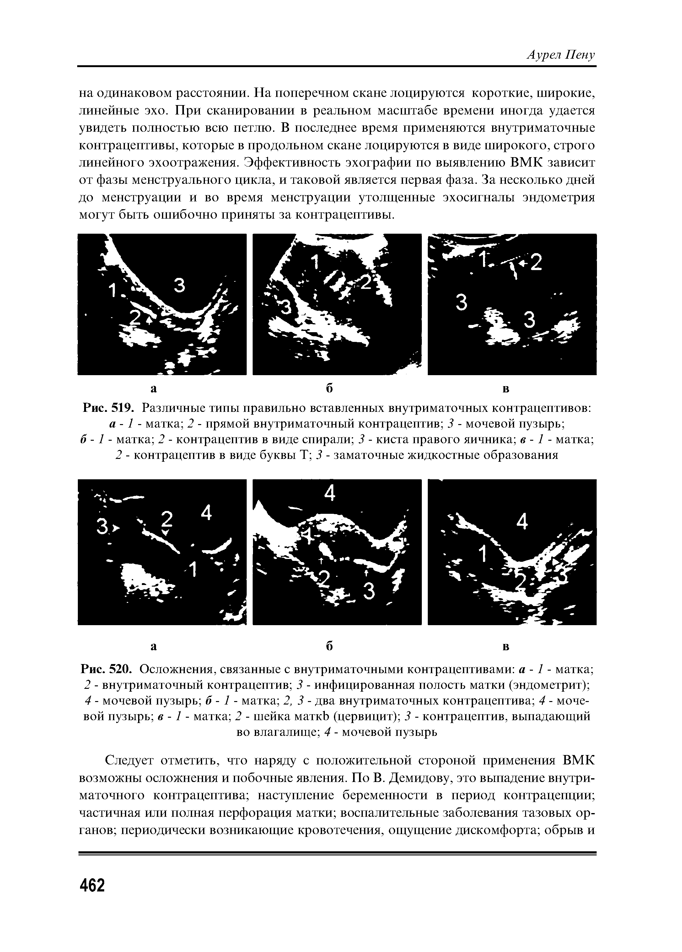 Рис. 520. Осложнения, связанные с внутриматочными контрацептивами а -1 - матка 2 - внутриматочный контрацептив 3 - инфицированная полость матки (эндометрит) 4 - мочевой пузырь б - 1 - матка 2, 3 - два внутриматочных контрацептива 4 - мочевой пузырь в -1 - матка 2 - шейка маткЬ (цервицит) 3 - контрацептив, выпадающий во влагалище 4 - мочевой пузырь...