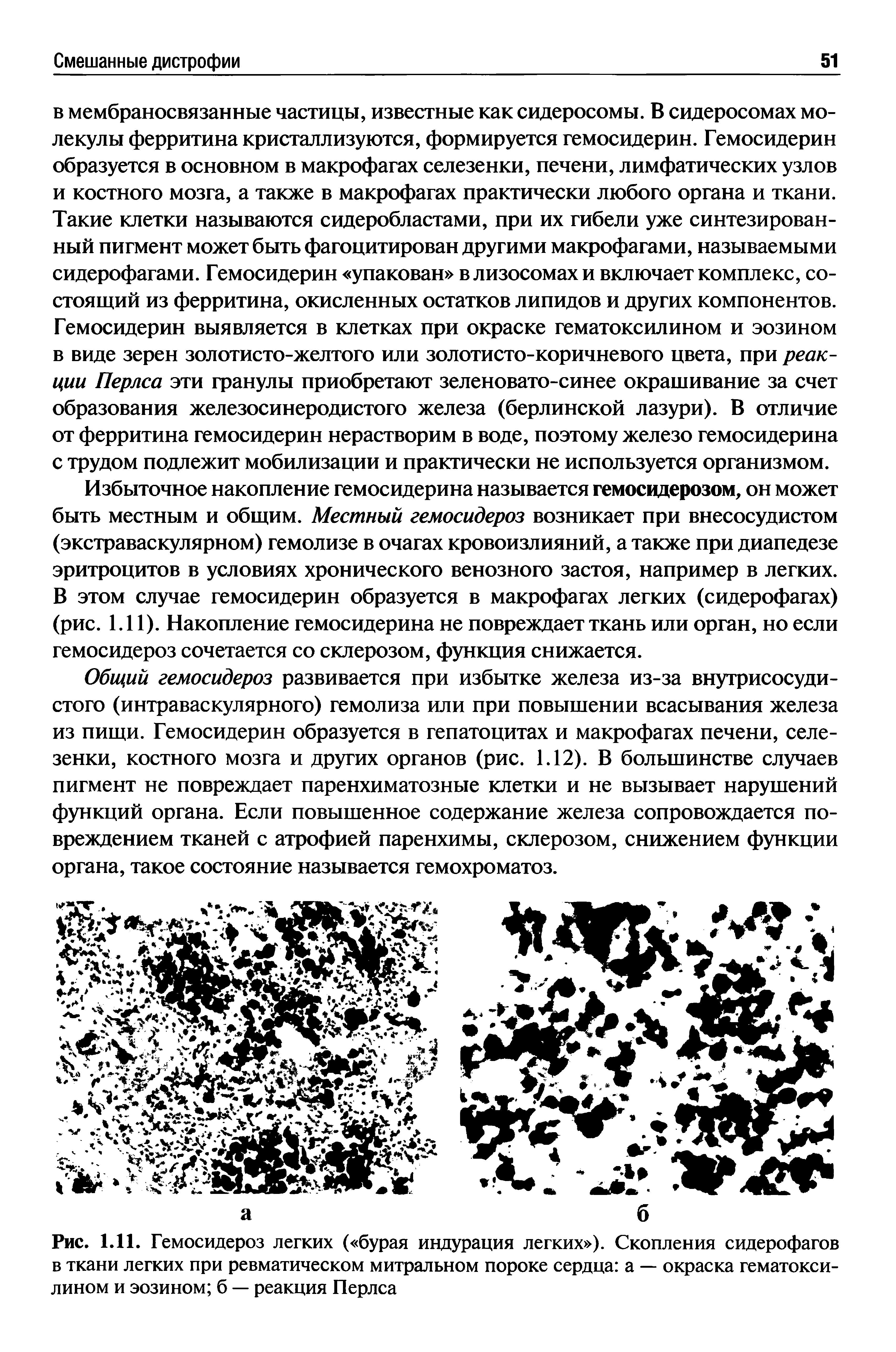 Рис. 1.11. Гемосидероз легких ( бурая индурация легких ). Скопления сидерофагов в ткани легких при ревматическом митральном пороке сердца а — окраска гематоксилином и эозином б — реакция Перлса...