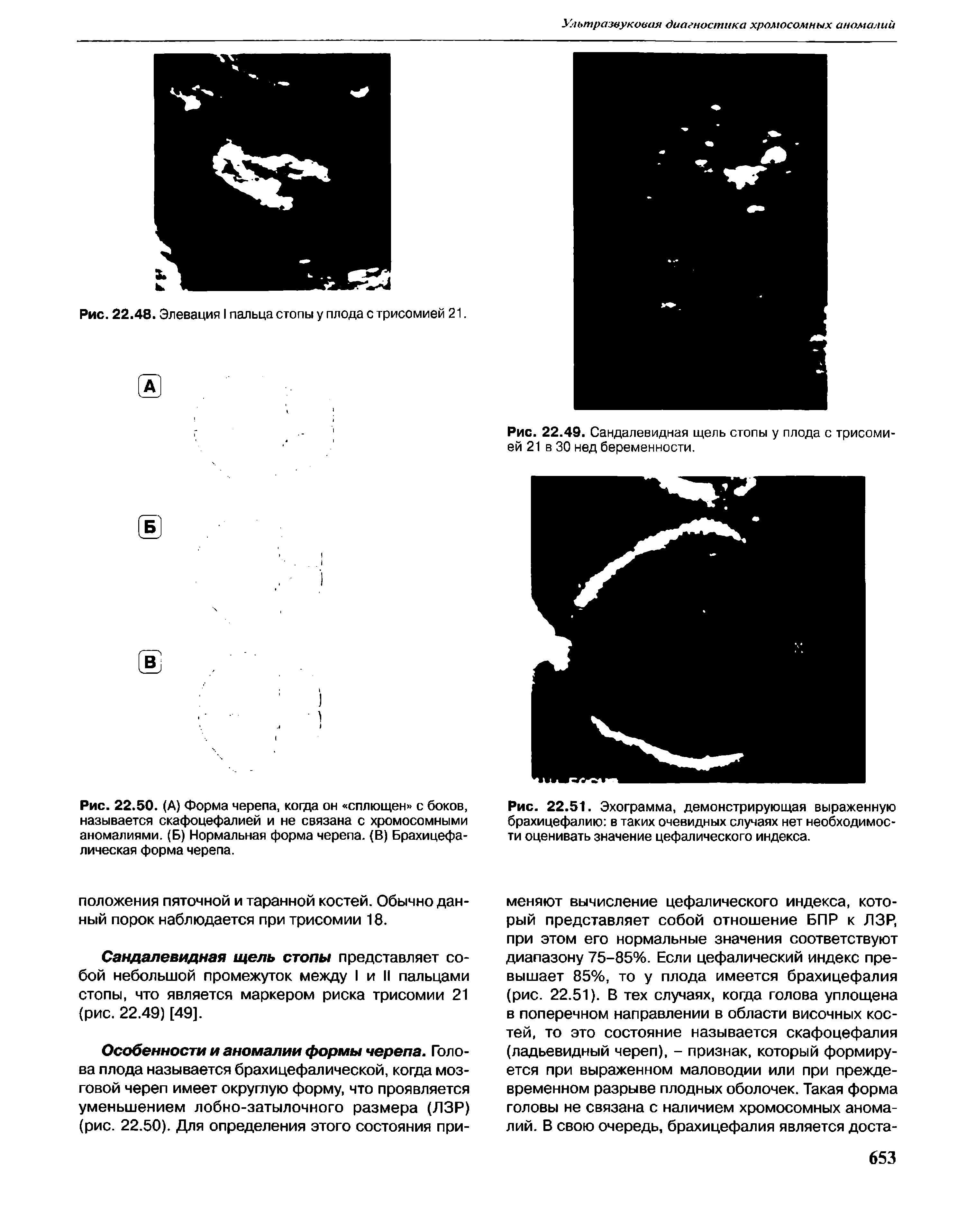 Рис. 22.50. (А) Форма черепа, когда он сплющен с боков, называется скафоцефалией и не связана с хромосомными аномалиями. (Б) Нормальная форма черепа. (В) Брахицефа-лическая форма черепа.