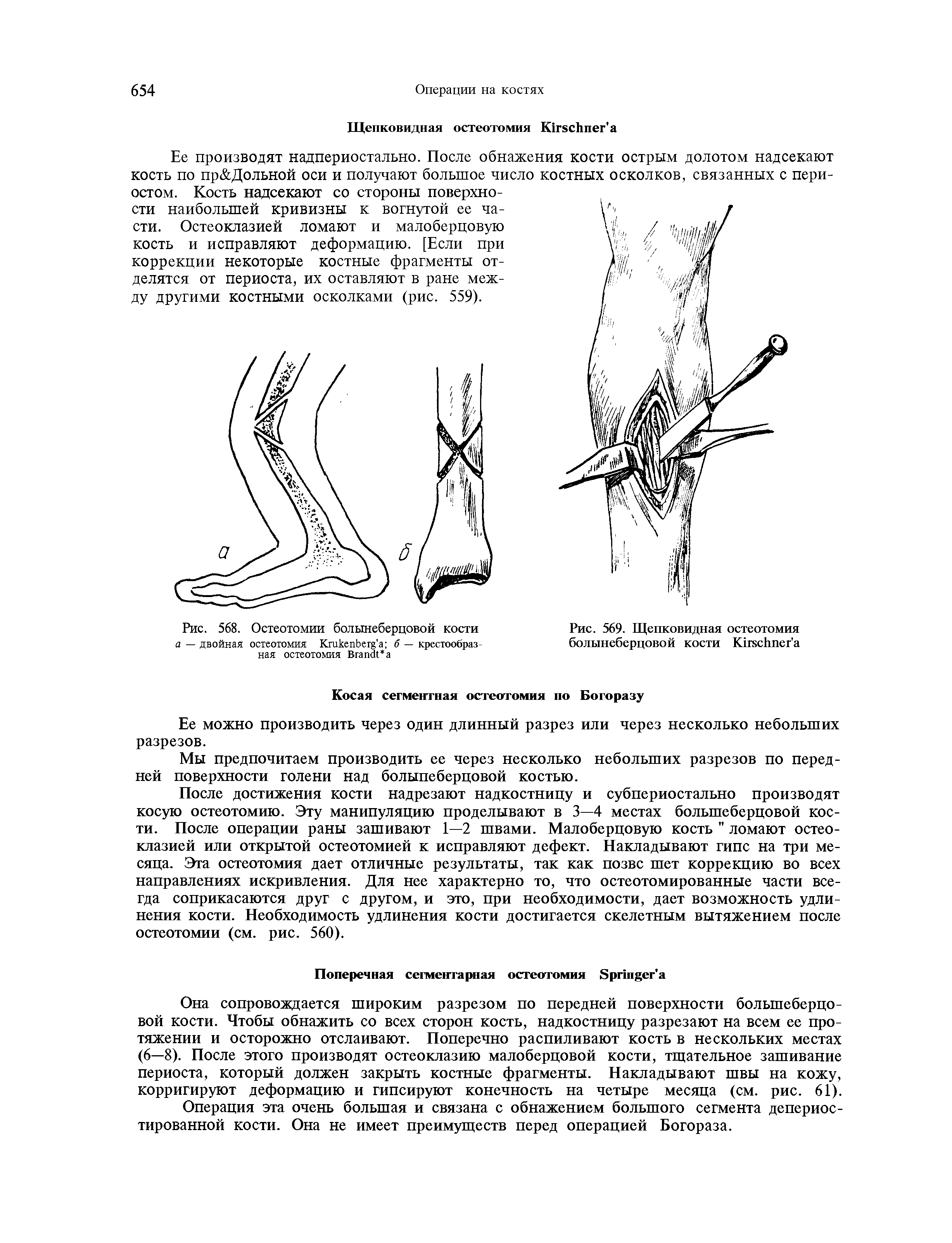 Рис. 568. Остеотомии большеберцовой кости а — двойная остеотомия КгикепЬе а б — крестообразная остеотомия ВгапЗПа...