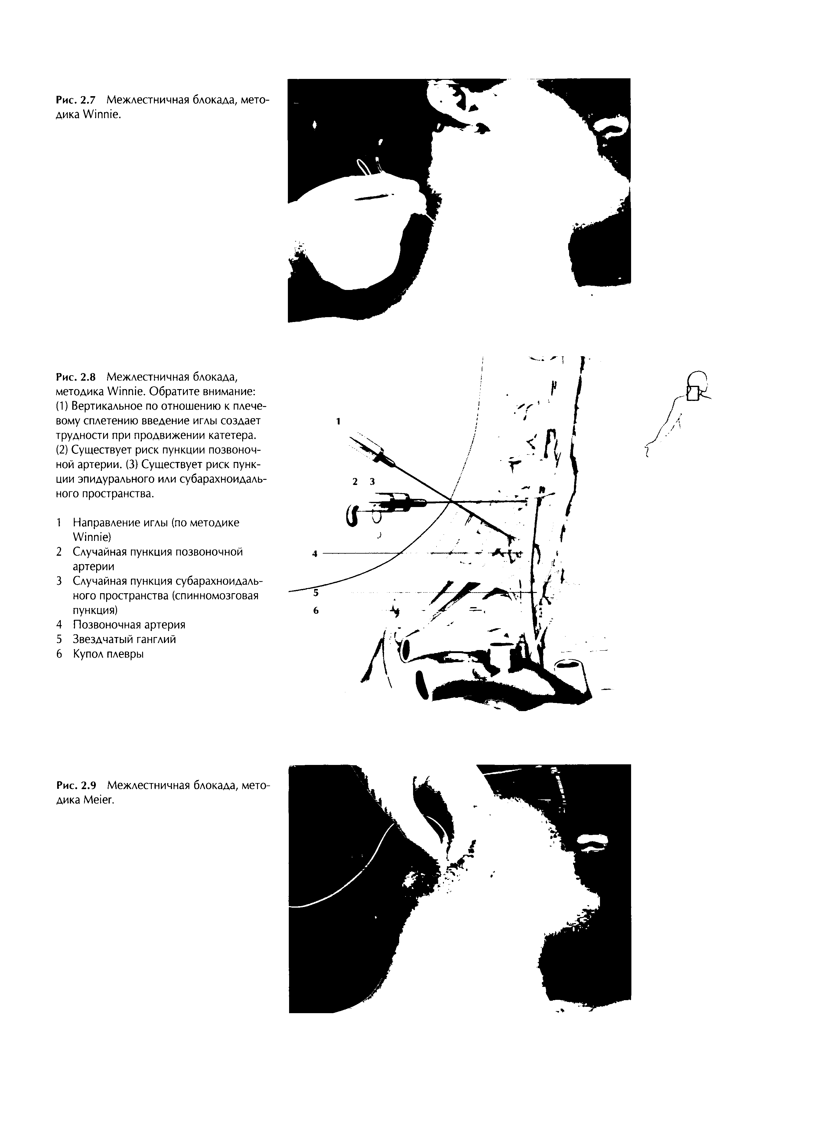 Рис. 2.8 Межлестничная блокада, методика W . Обратите внимание ...