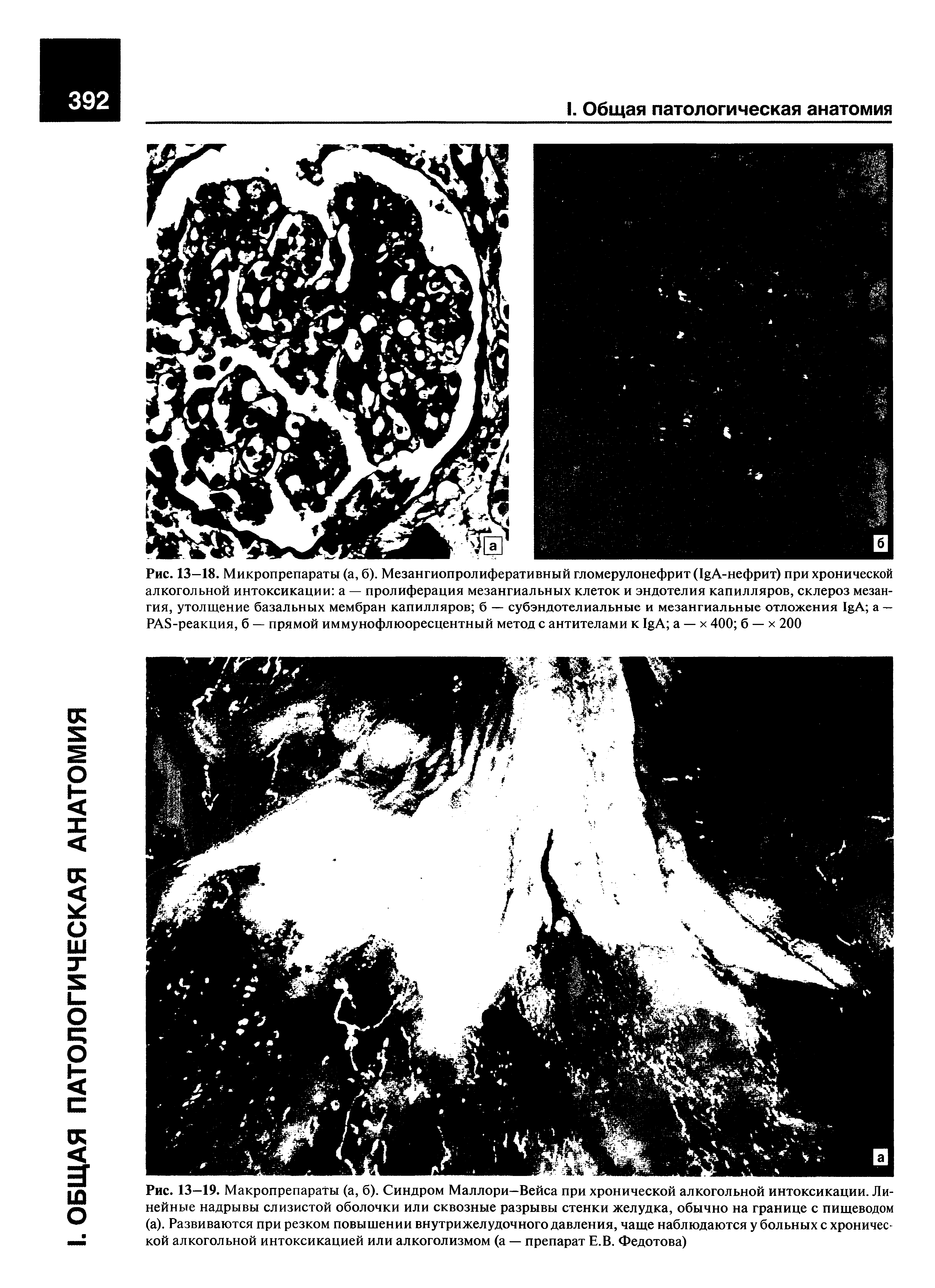 Рис. 13—18. Микропрепараты (а, б). Мезангиопролиферативный гломерулонефрит (I A-нефрит) при хронической алкогольной интоксикации а — пролиферация мезангиальных клеток и эндотелия капилляров, склероз мезангия, утолщение базальных мембран капилляров б — субэндотелиальные и мезангиальные отложения I A а — PAS-реакция, б — прямой иммунофлюоресцентный метод с антителами к I A а — х 400 б — х 200...