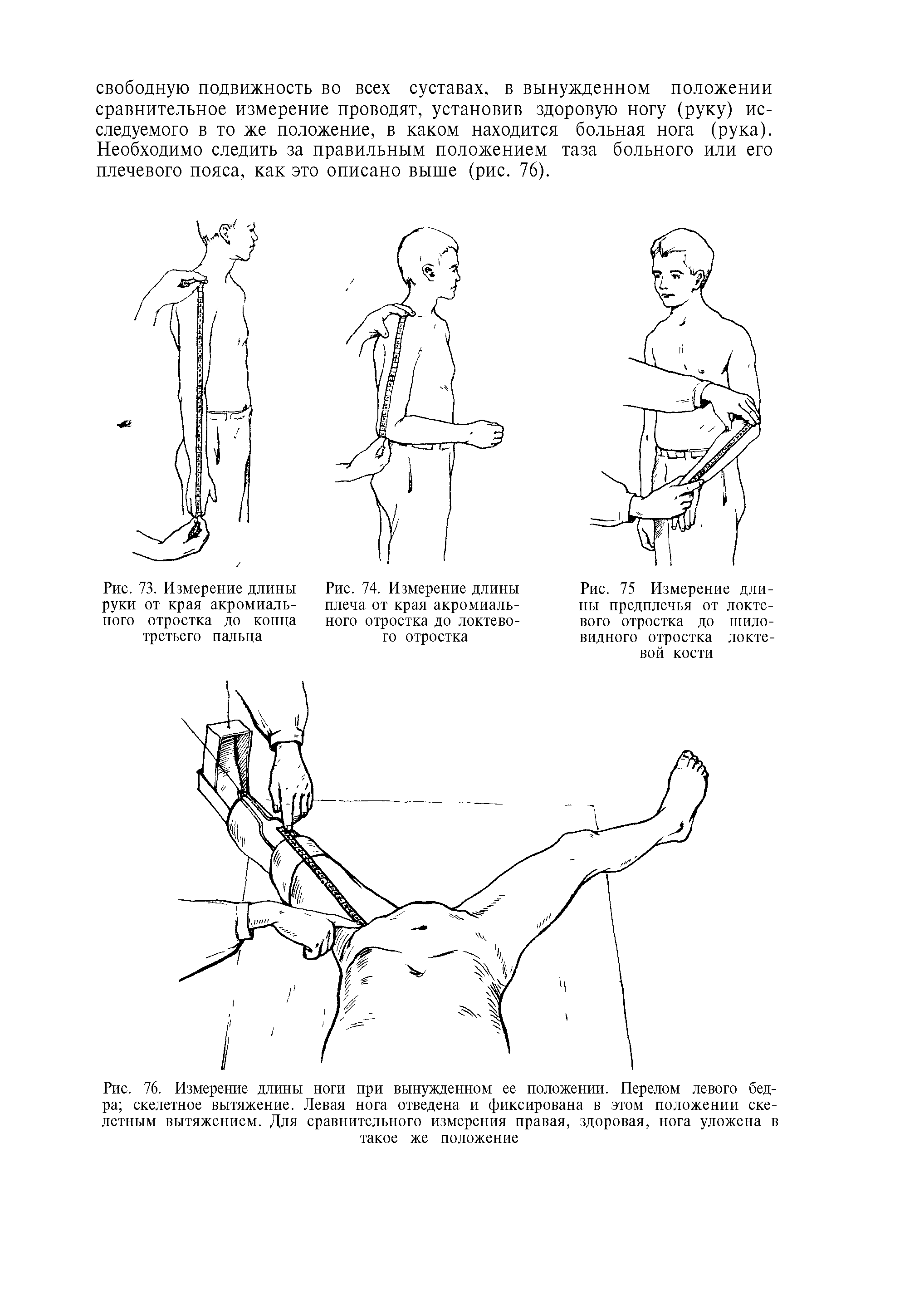 Рис. 75 Измерение длины предплечья от локтевого отростка до шиловидного отростка локтевой кости...