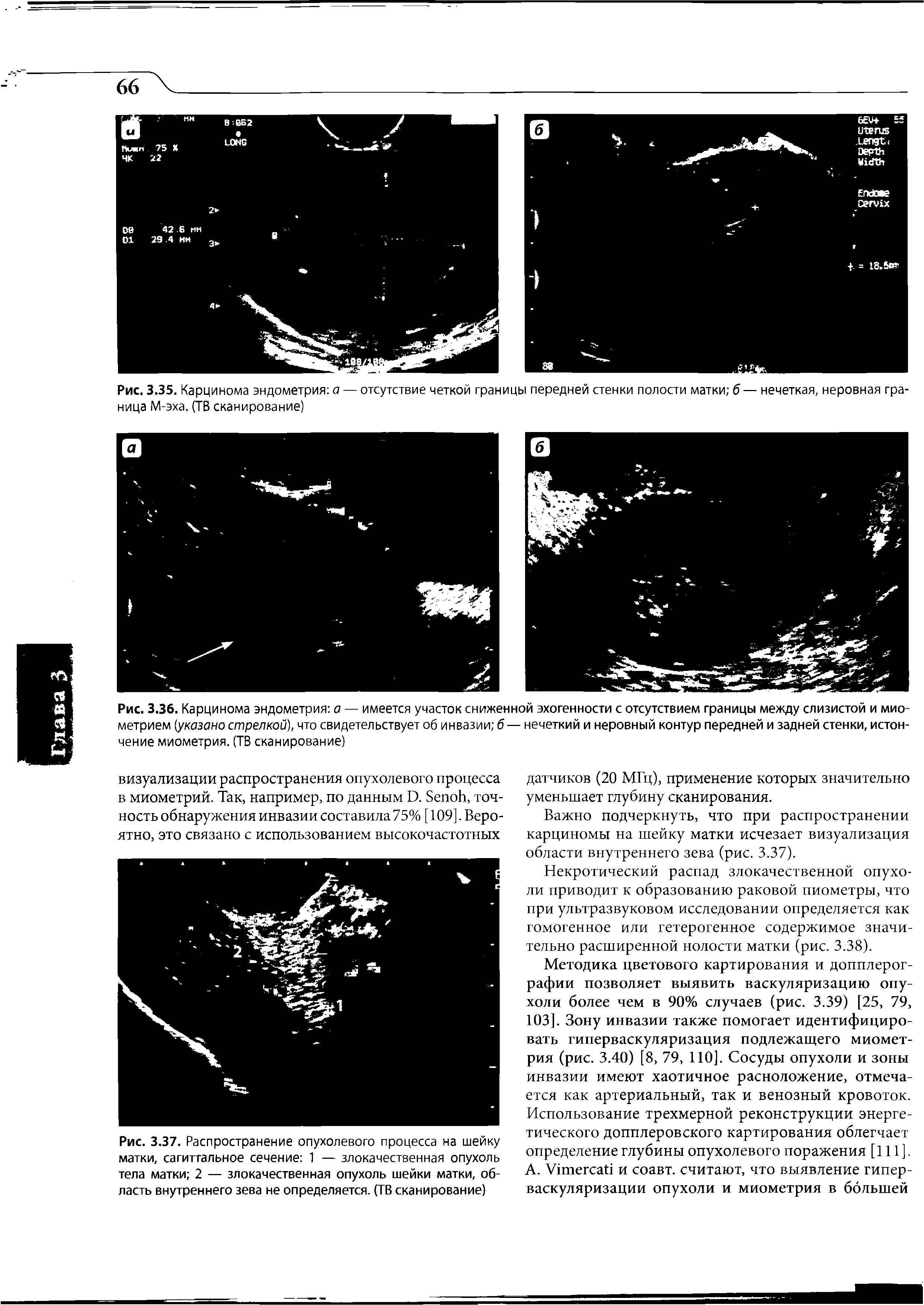 Рис. 3.36. Карцинома эндометрия а — имеется участок сниженной эхогенности с отсутствием границы между слизистой и миометрием (указано стрелкой), что свидетельствует об инвазии б — нечеткий и неровный контур передней и задней стенки, истончение миометрия. (ТВ сканирование)...
