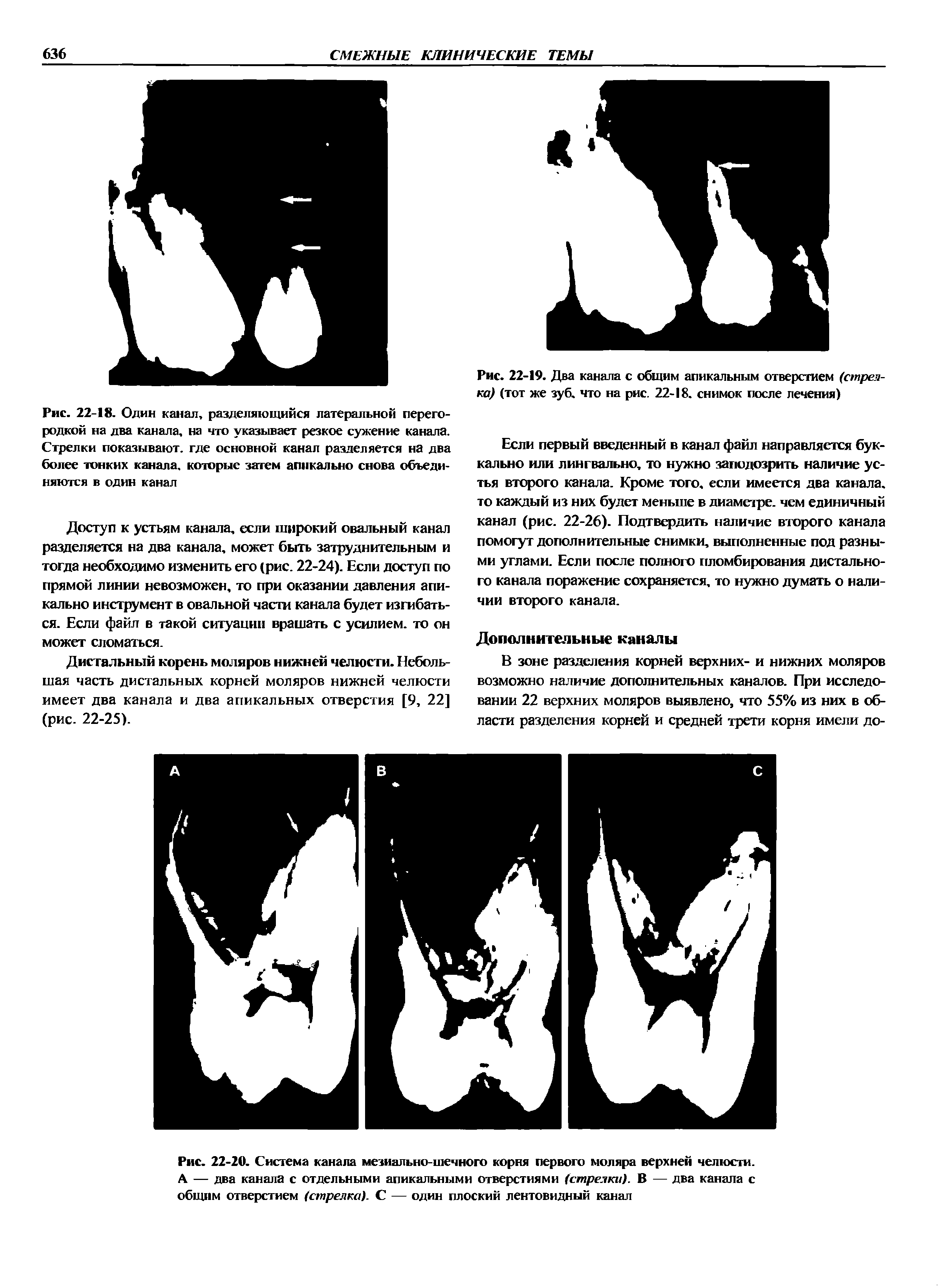 Рис. 22-20. Система канала мезиально-шечного корня первого моляра верхней челюсти. А — два канала с отдельными апикальными отверстиями (стрелки). В — два канала с общим отверстием (стрелка). С — один плоский лентовидный канал...
