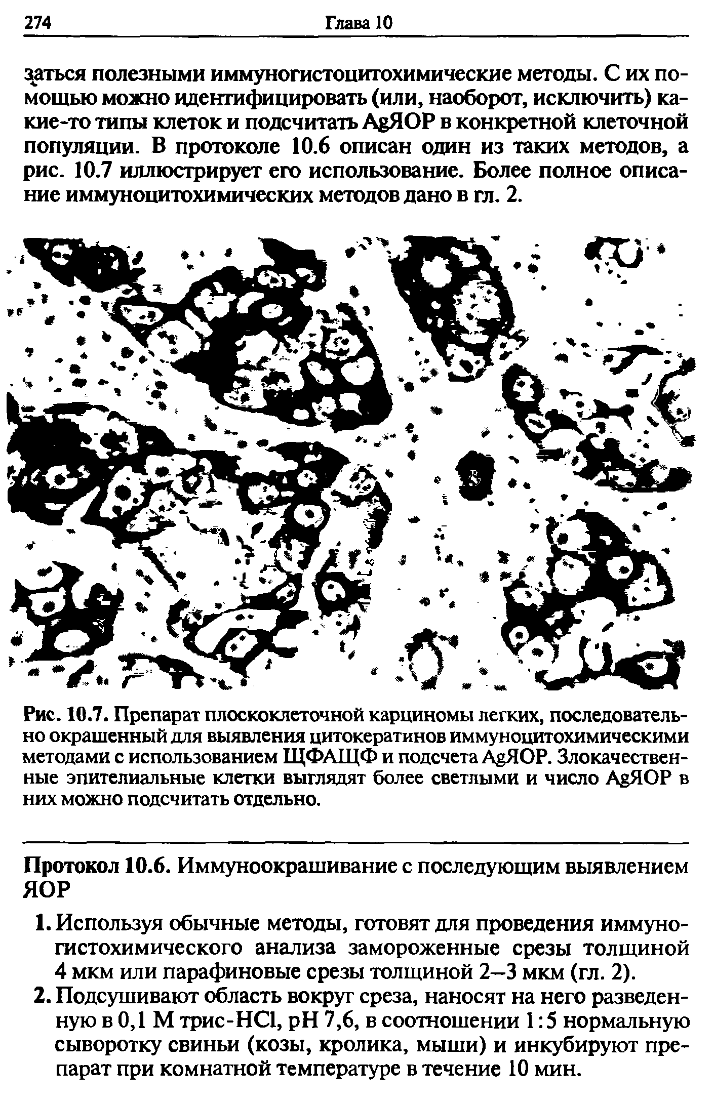 Рис. 10.7. Препарат плоскоклеточной карциномы легких, последовательно окрашенный для выявления цитокератинов иммуноцитохимическими методами с использованием ЩФАЩФ и подсчета АйЯОР. Злокачественные эпителиальные клетки выглядят более светлыми и число АяЯОР в них можно подсчитать отдельно.