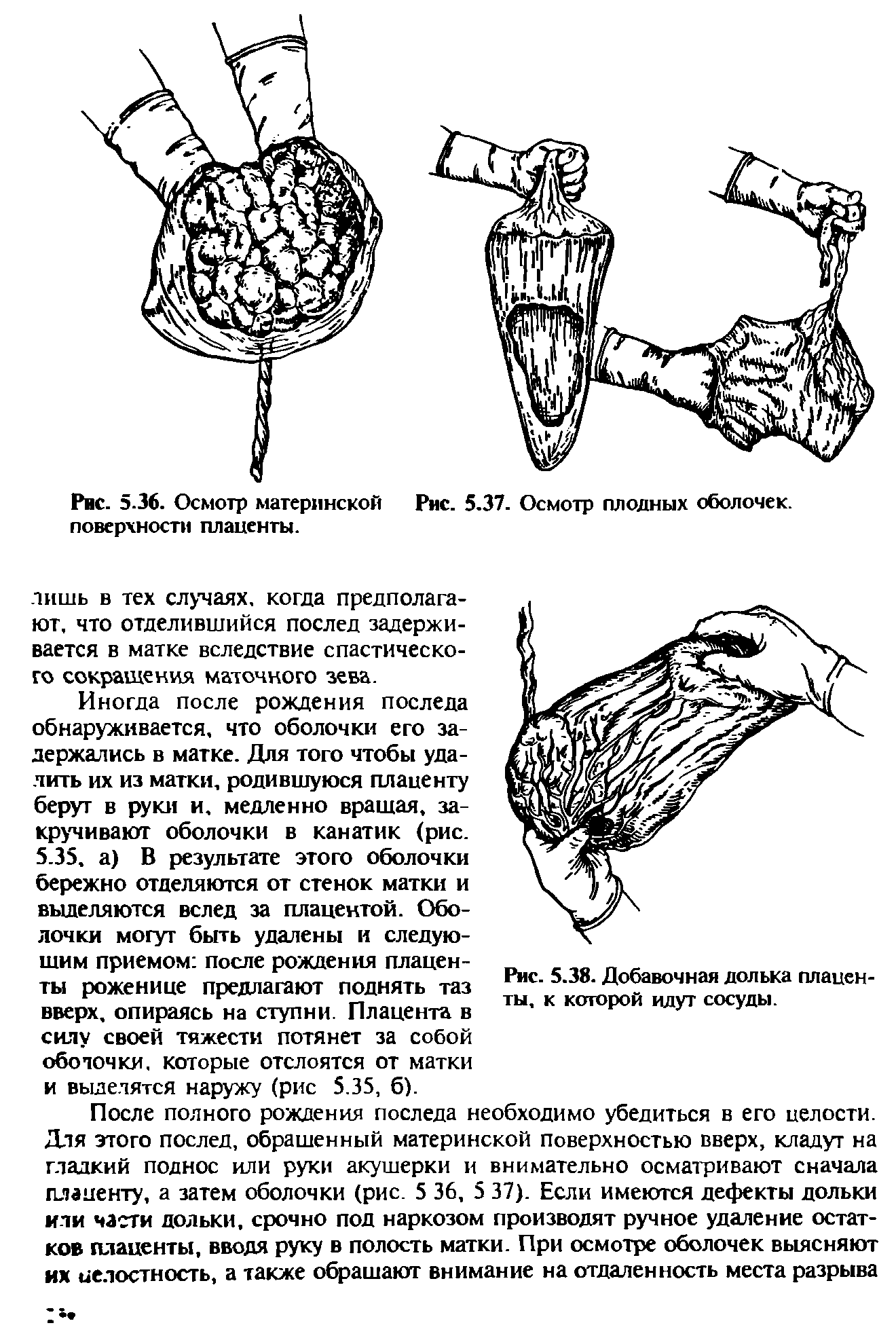 Рис. 5.38. Добавочная долька плаценты, к которой идут сосуды.