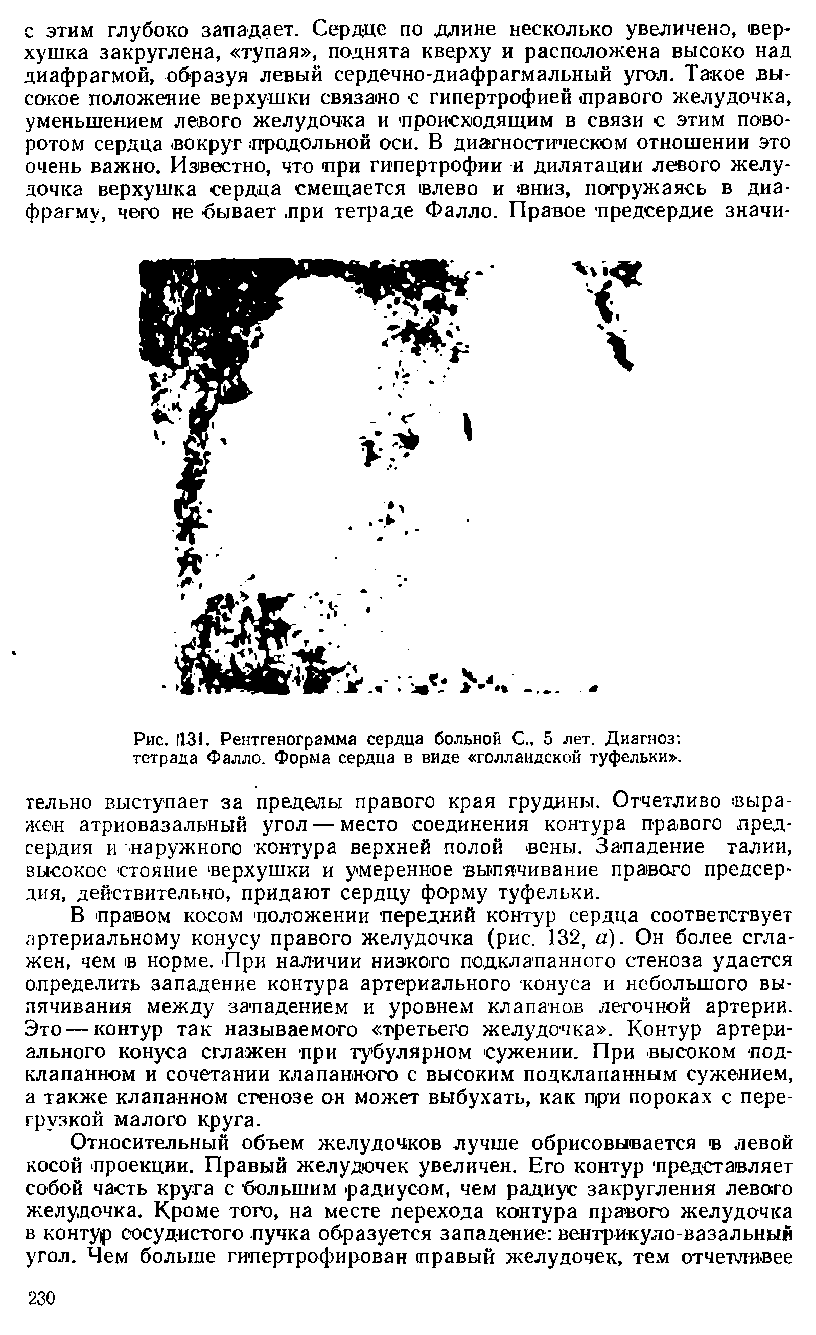 Рис. 1131. Рентгенограмма сердца больной С., 5 лет. Диагноз тетрада Фалло. Форма сердца в виде голландской туфельки .