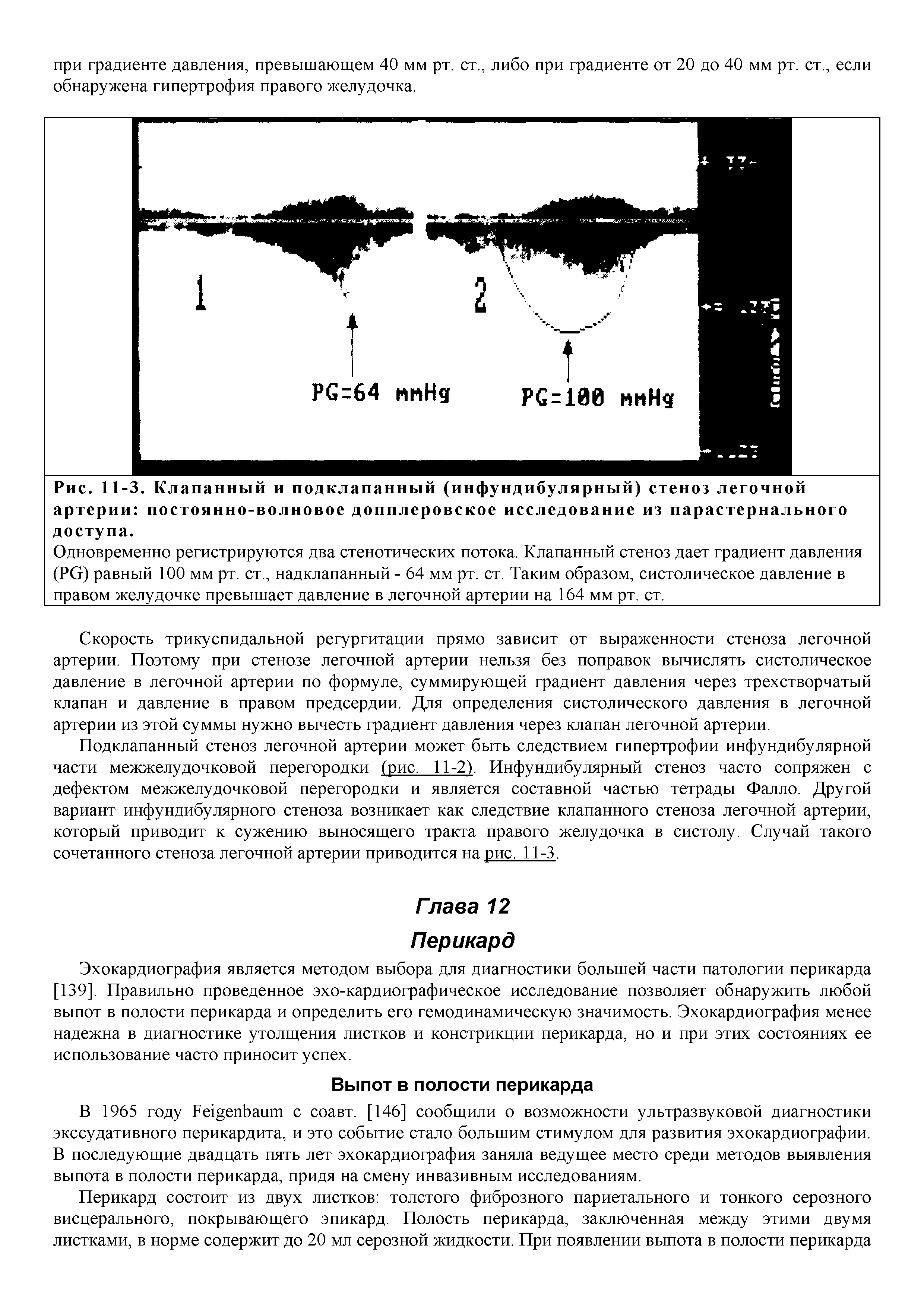 Рис. 11-3. Клапанный и подклапанный (инфундибулярный) стеноз легочной артерии постоянно-волновое допплеровское исследование из парастернального доступа.