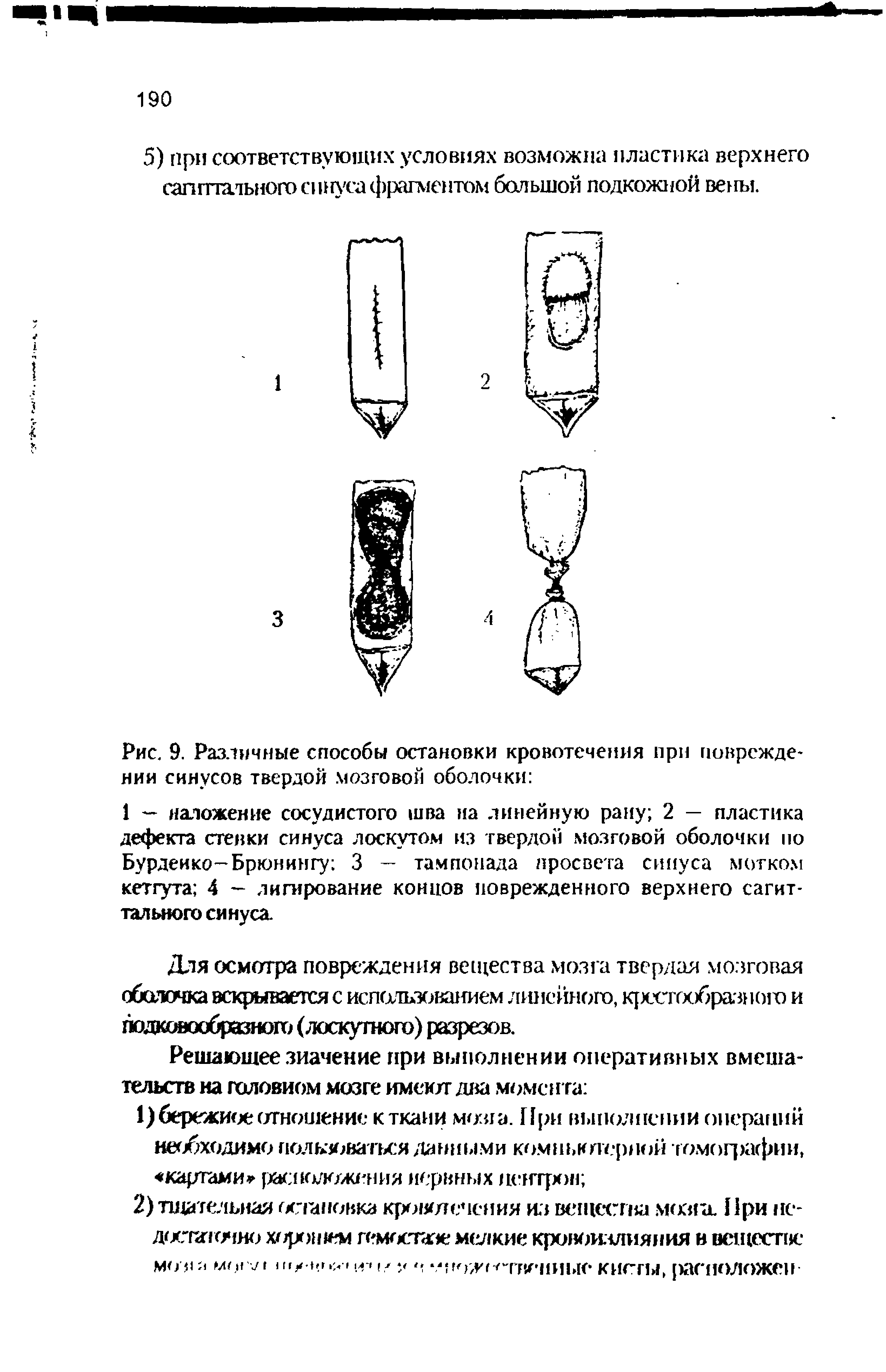 Рис. 9. Различные способы остановки кровотечения при повреждении синусов твердой. мозговой оболочки ...