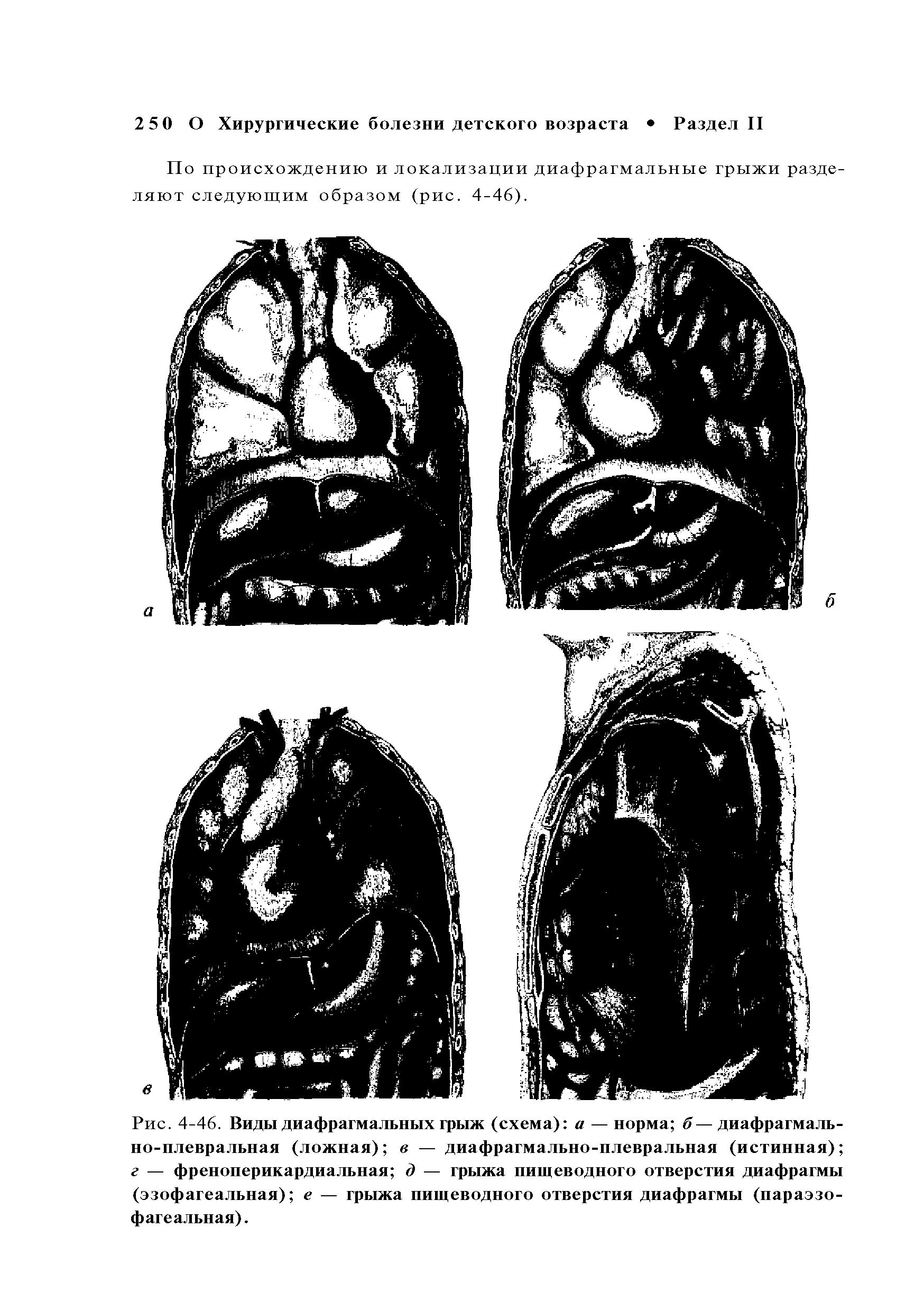 Рис. 4-46. Виды диафрагмальных грыж (схема) а — норма б—диафрагмально-плевральная (ложная) в — диафрагмально-плевральная (истинная) г — френоперикардиальная д — грыжа пищеводного отверстия диафрагмы (эзофагеальная) е — грыжа пищеводного отверстия диафрагмы (параэзо-фагеальная).