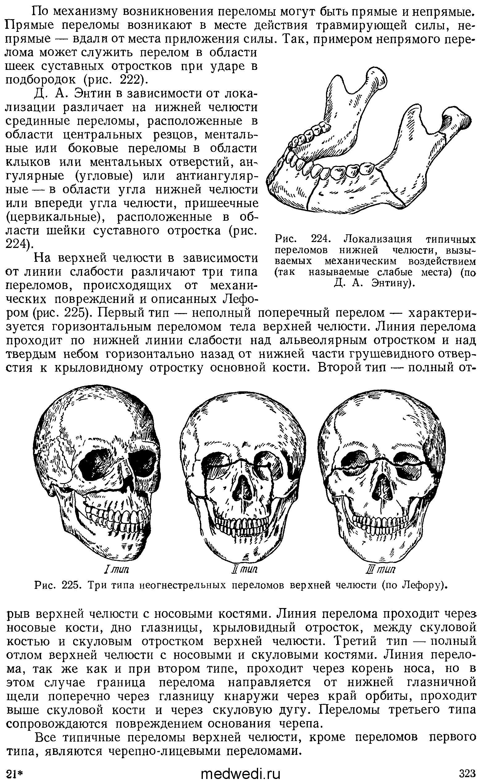 Рис. 225. Три типа неогнестрельных переломов верхней челюсти (по Лефору).