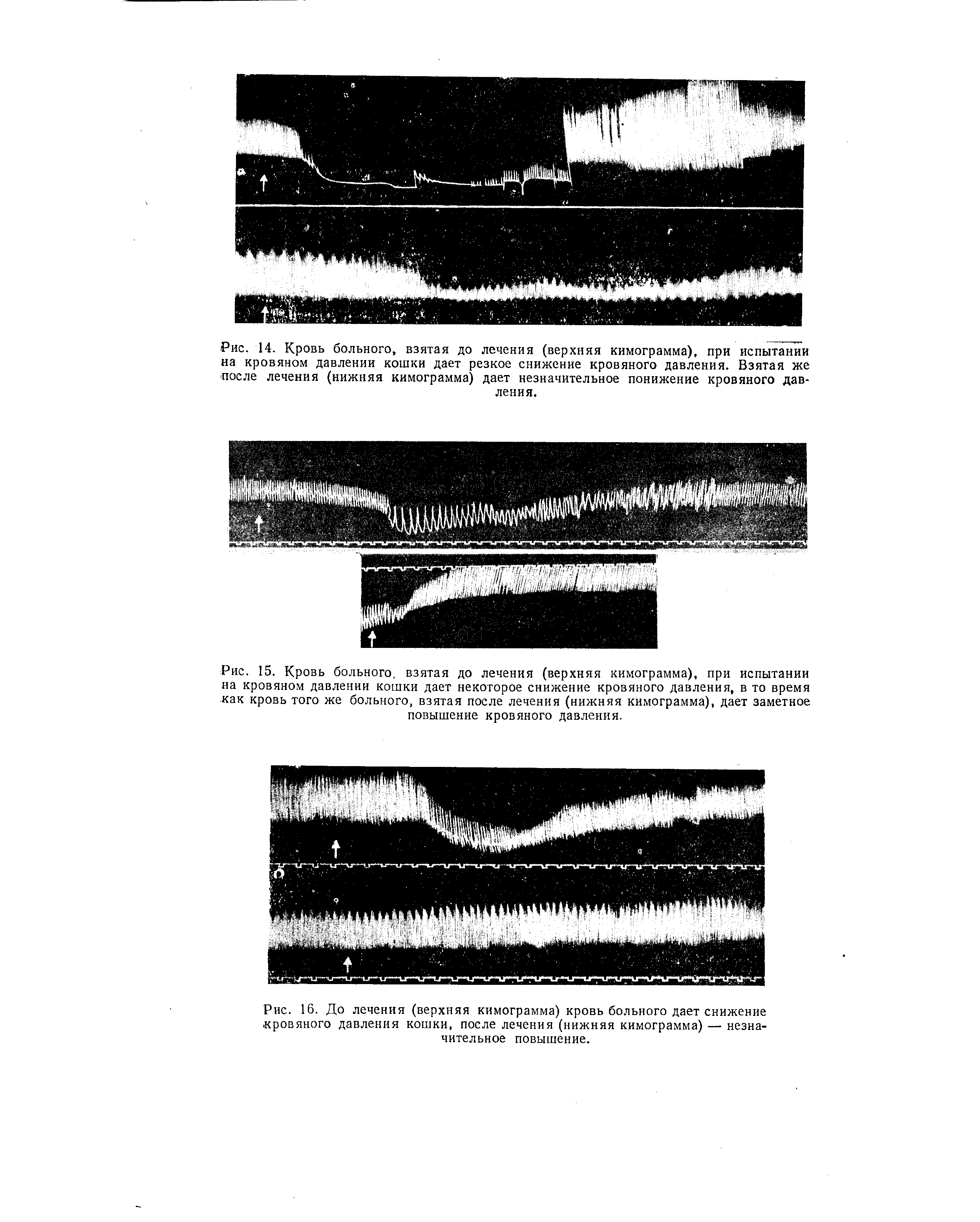 Рис. 15. Кровь больного, взятая до лечения (верхняя кимограмма), при испытании на кровяном давлении кошки дает некоторое снижение кровяного давления, в то время как кровь того же больного, взятая после лечения (нижняя кимограмма), дает заметное повышение кровяного давления.