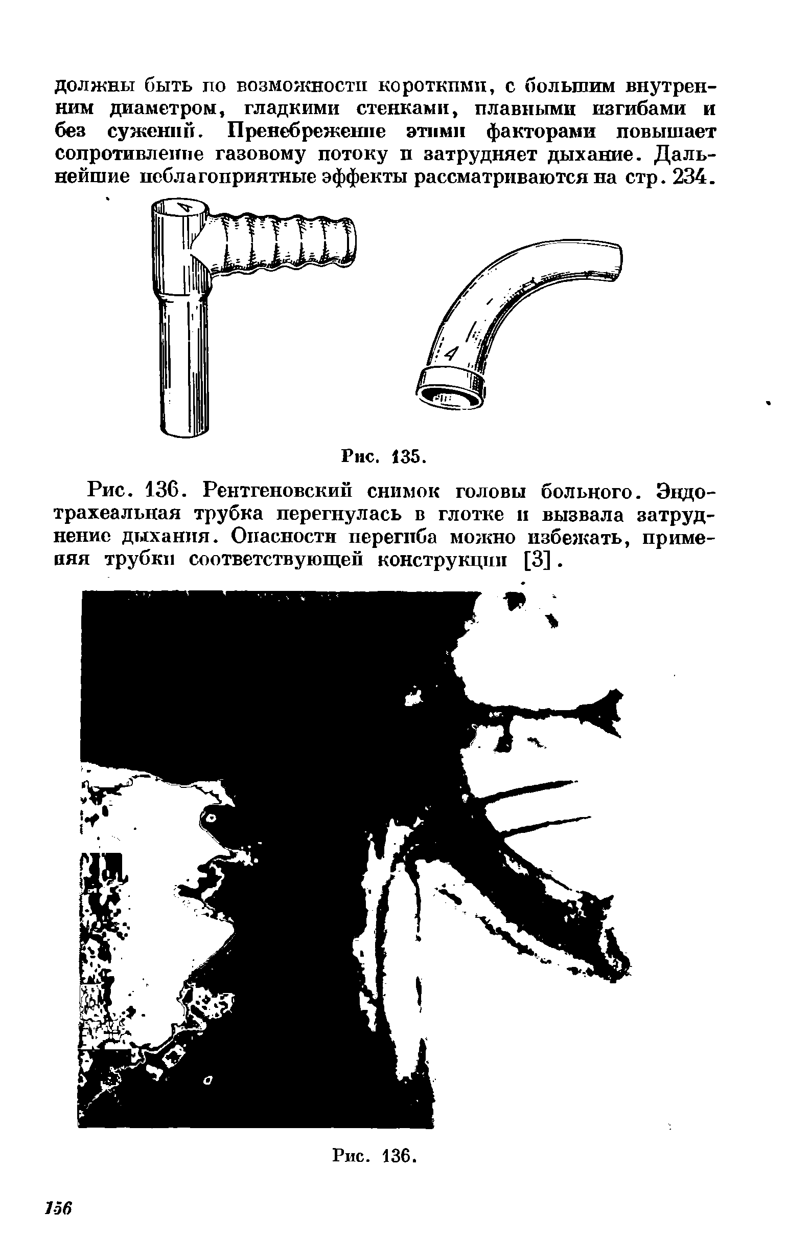 Рис. 136. Рентгеновский снимок головы больного. Эндо-трахеальная трубка перегнулась в глотке и вызвала затруднение дыхания. Опасности перегиба можно избежать, применяя трубки соответствующей конструкции [3]. ...