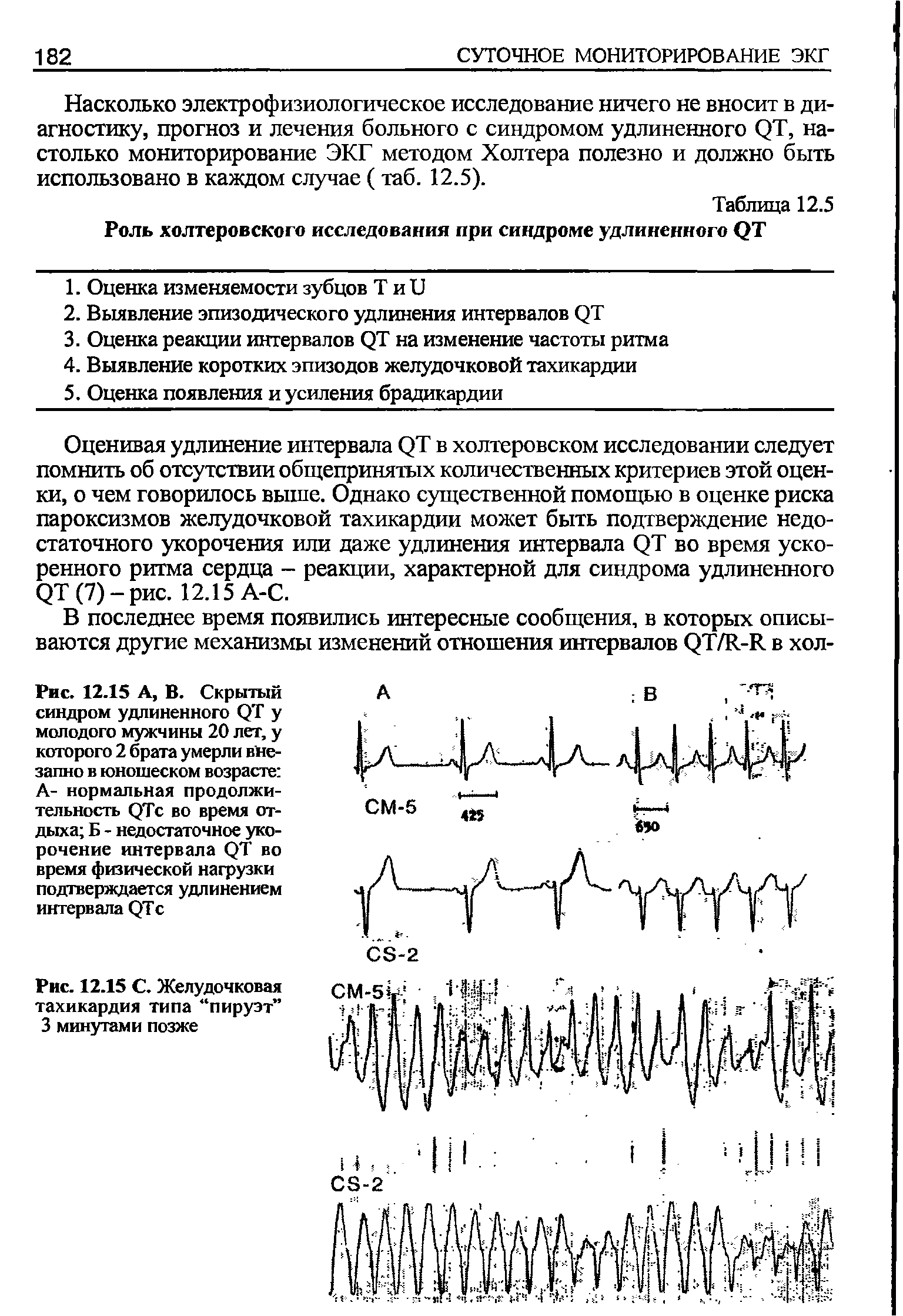 Рис. 12.15 А, В. Скрытый синдром удлиненного ОТ у молодого мужчины 20 лет, у которого 2 брата умерли внезапно в юношеском возрасте А- нормальная продолжительность ОТс во время отдыха Б - недостаточное укорочение интервала ОТ во время физической нагрузки подтверждается удлинением интервала ОТс...