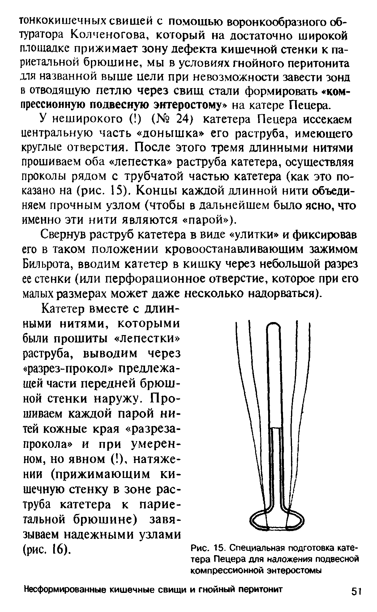 Рис. 15. Специальная подготовка катетера Пецера для наложения подвесной компрессионной энтеростомы...