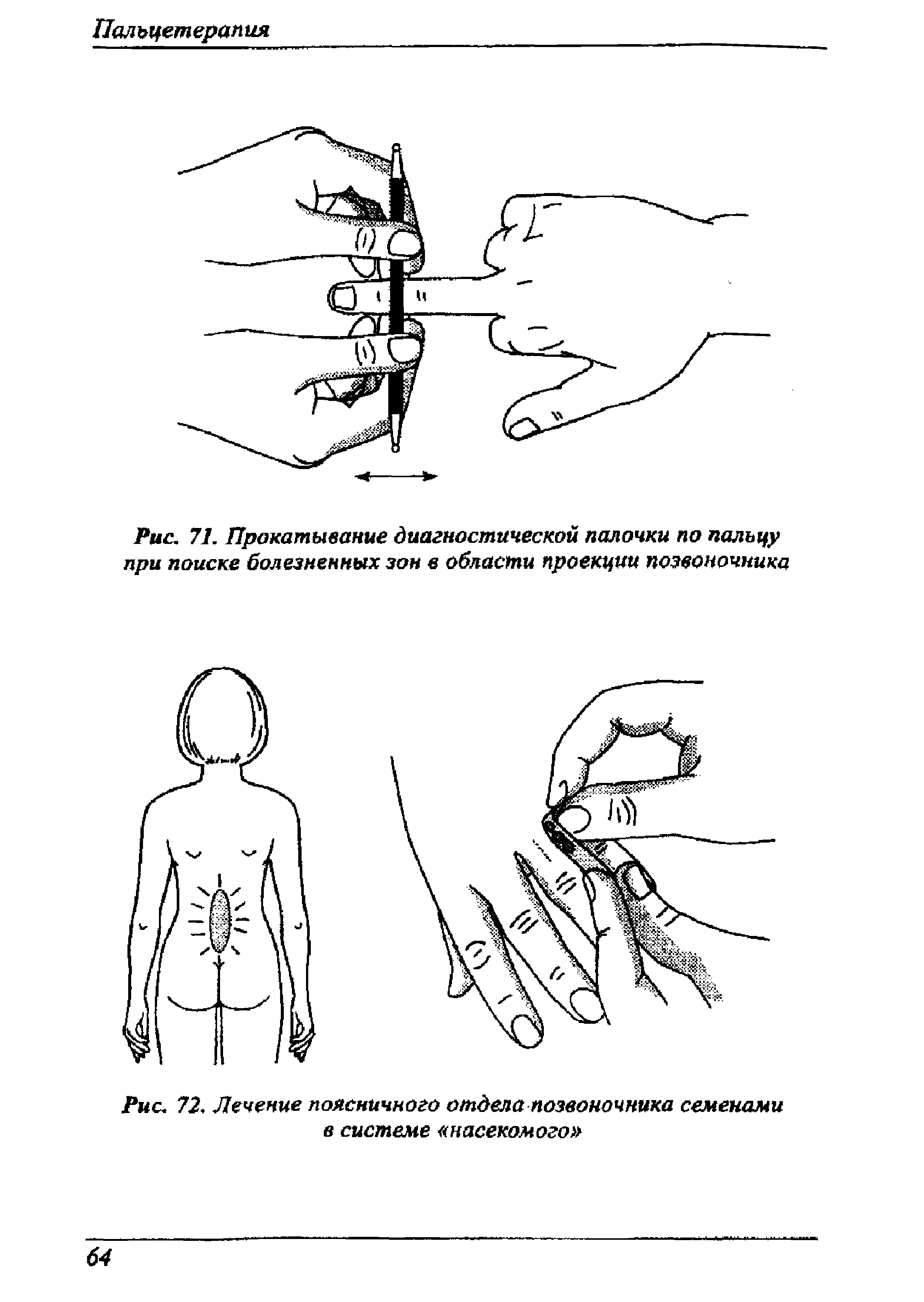 Рис. 71. Прокатывание диагностической палочки по пальцу при поиске болезненных зон в области проекции позвоночника...