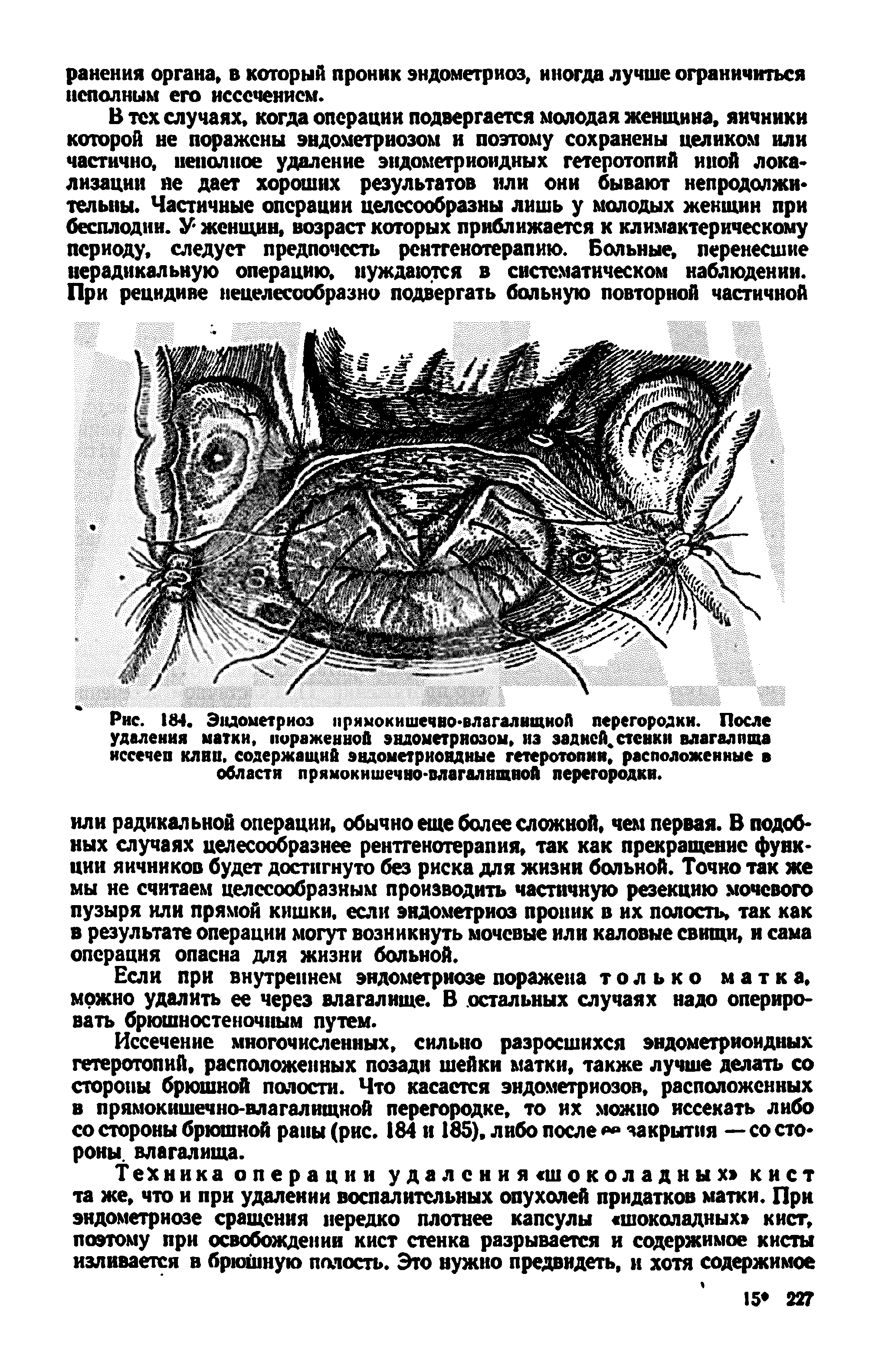 Рис. 184. Эндометриоз прямокишечно-влагалищной перегородки. После удаления матки, пораженной эндометриозом, из задней.стенки влагалища иссечен клин, содержащий эндометриоидные гетеротопии, расположенные области прямокишечно-влагалищной перегородки.